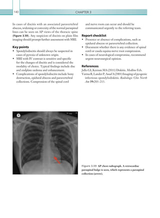 Chapter 3140
and nerve roots can occur and should be
communicated urgently to the referring team.
Report checklist
•	 Presence or absence of complications, such as
epidural abscess or paravertebral collection.
•	 Document whether there is any evidence of spinal
cord or cauda equina nerve root compression.
•	 In cases of neurological compromise, recommend
urgent neurosurgical opinion.
References
Jallo GI, Keenan MA (2011) Diskitis. Medline Feb.
VarmaR,LanderP,AssafA(2001)Imagingofpyogenic
infectious spondylodiskitis. Radiologic Clin North
Am 39:203–213.
In cases of discitis with an associated paravertebral
abscess, widening or convexity of the normal paraspinal
lines can be seen on AP views of the thoracic spine
(Figure 3.59). Any suspicion of discitis on plain film
imaging should prompt further assessment with MRI.
Key points
•	 Spondylodiscitis should always be suspected in
cases of pyrexia of unknown origin.
•	 MRI with IV contrast is sensitive and specific
for the changes of discitis and is considered the
modality of choice. Typical findings include disc
and endplate oedema and enhancement.
•	 Complications of spondylodiscitis include bony
destruction, epidural abscess and paravertebral
collections. Compression of the spinal cord
Figure 3.59  AP chest radiograph. A retrocardiac
paraspinal bulge is seen, which represents a paraspinal
collection (arrow).
K22247_C003.indd 140 16/05/15 3:09 AM
 