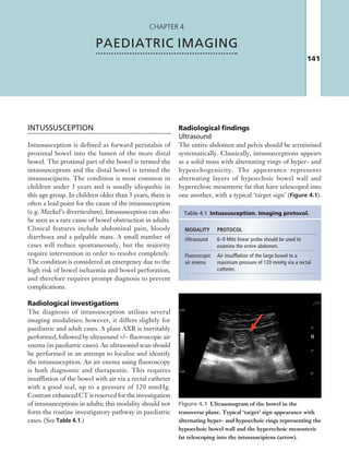 141
Chapter 4
PAEDIATRIC IMAGING
INTUSSUSCEPTION
Intussusception is defined as forward peristalsis of
proximal bowel into the lumen of the more distal
bowel. The proximal part of the bowel is termed the
intussusceptum and the distal bowel is termed the
intussuscipiens. The condition is most common in
children under 3 years and is usually idiopathic in
this age group. In children older than 3 years, there is
often a lead point for the cause of the intussusception
(e.g. Meckel’s diverticulum). Intussusception can also
be seen as a rare cause of bowel obstruction in adults.
Clinical features include abdominal pain, bloody
diarrhoea and a palpable mass. A small number of
cases will reduce spontaneously, but the majority
require intervention in order to resolve completely.
The condition is considered an emergency due to the
high risk of bowel ischaemia and bowel perforation,
and therefore requires prompt diagnosis to prevent
complications.
Radiological investigations
The diagnosis of intussusception utilises several
imaging modalities; however, it differs slightly for
paediatric and adult cases. A plain AXR is inevitably
performed, followed by ultrasound +/− fluoroscopic air
enema (in paediatric cases). An ultrasound scan should
be performed in an attempt to localise and identify
the intussusception. An air enema using fluoroscopy
is both diagnostic and therapeutic. This requires
insufflation of the bowel with air via a rectal catheter
with a good seal, up to a pressure of 120 mmHg.
Contrast enhanced CT is reserved for the investigation
of intussusceptions in adults; this modality should not
form the routine investigatory pathway in paediatric
cases. (See Table 4.1.)
Radiological findings
Ultrasound
The entire abdomen and pelvis should be scrutinised
systematically. Classically, intussusceptions appears
as a solid mass with alternating rings of hyper- and
hypoechogenicity. The appearance represents
alternating layers of hypoechoic bowel wall and
hyperechoic mesenteric fat that have telescoped into
one another, with a typical ‘target sign’ (Figure 4.1).
MODALITY PROTOCOL
Ultrasound 6–9 MHz linear probe should be used to
examine the entire abdomen.
Fluoroscopic
air enema
Air insufflation of the large bowel to a
maximum pressure of 120 mmHg via a rectal
catheter.
Table 4.1  Intussusception. Imaging protocol.
Figure 4.1  Ultrasonogram of the bowel in the
transverse plane. Typical ‘target’ sign appearance with
alternating hyper- and hypoechoic rings representing the
hypoechoic bowel wall and the hyperechoic mesenteric
fat telescoping into the intussuscipiens (arrow).
K22247_C004.indd 141 16/05/15 3:10 AM
 