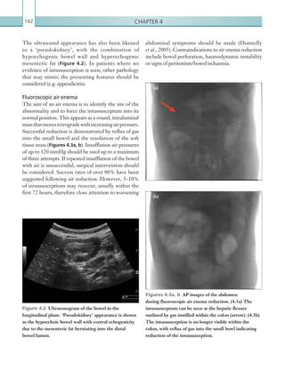 Chapter 4142
The ultrasound appearance has also been likened
to a ‘pseudokidney’, with the combination of
hypoechogenic bowel wall and hyperechogenic
mesenteric fat (Figure 4.2). In patients where no
evidence of intussusception is seen, other pathology
that may mimic the presenting features should be
considered (e.g. appendicitis).
Fluoroscopic air enema
The aim of an air enema is to identify the site of the
abnormality and to force the intussusceptum into its
normal position. This appears as a round, intraluminal
massthatmovesretrogradewithincreasingairpressure.
Successful reduction is demonstrated by reflux of gas
into the small bowel and the resolution of the soft
tissue mass (Figures 4.3a, b). Insufflation air pressures
of up to 120 mmHg should be used up to a maximum
of three attempts. If repeated insufflation of the bowel
with air is unsuccessful, surgical intervention should
be considered. Success rates of over 80% have been
suggested following air reduction. However, 5–10%
of intussusceptions may reoccur, usually within the
first 72 hours, therefore close attention to worsening
Figure 4.2  Ultrasonogram of the bowel in the
longitudinal plane. ‘Pseudokidney’ appearance is shown
as the hypoechoic bowel wall with central echogenicity
due to the mesenteric fat herniating into the distal
bowel lumen.
Figures 4.3a, b  AP images of the abdomen
during fluoroscopic air enema reduction. (4.3a) The
intussusceptum can be seen at the hepatic flexure
outlined by gas instilled within the colon (arrow). (4.3b)
The intussusception is no longer visible within the
colon, with reflux of gas into the small bowl indicating
reduction of the intussusception.
abdominal symptoms should be made (Donnelly
et al., 2005). Contraindications to air enema reduction
include bowel perforation, haemodynamic instability
or signs of peritonism/bowel ischaemia.
(a)
(b)
K22247_C004.indd 142 16/05/15 3:10 AM
 