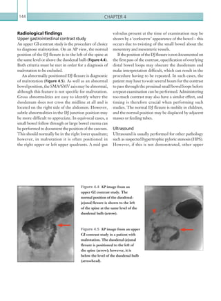 Chapter 4144
Radiological findings
Upper gastrointestinal contrast study
An upper GI contrast study is the procedure of choice
to diagnose malrotation. On an AP view, the normal
position of the DJ flexure is to the left of the spine at
the same level or above the duodenal bulb (Figure 4.4).
Both criteria must be met in order for a diagnosis of
malrotation to be excluded.
An abnormally positioned DJ flexure is diagnostic
of malrotation (Figure 4.5). As well as an abnormal
bowel position, the SMA/SMV axis may be abnormal,
although this feature is not specific for malrotation.
Gross abnormalities are easy to identify where the
duodenum does not cross the midline at all and is
located on the right side of the abdomen. However,
subtle abnormalities in the DJ junction position may
be more difficult to appreciate. In equivocal cases, a
small bowel follow through or large bowel enema can
be performed to document the position of the caecum.
This should normally be in the right lower quadrant;
however, in malrotation it is often positioned in
the right upper or left upper quadrants. A mid-gut
Figure 4.4  AP image from an
upper GI contrast study. The
normal position of the duodenal-
jejunal flexure is shown to the left
of the spine at the same level of the
duodenal bulb (arrow).
Figure 4.5  AP image from an upper
GI contrast study in a patient with
malrotation. The duodenal-jejunal
flexure is positioned to the left of
the spine (arrow); however, it is
below the level of the duodenal bulb
(arrowhead).
volvulus present at the time of examination may be
shown by a ‘corkscrew’ appearance of the bowel – this
occurs due to twisting of the small bowel about the
mesentery and mesenteric vessels.
IfthepositionoftheDJflexureisnotdocumentedon
the first pass of the contrast, opacification of overlying
distal bowel loops may obscure the duodenum and
make interpretation difficult, which can result in the
procedure having to be repeated. In such cases, the
patient may have to wait several hours for the contrast
to pass through the proximal small bowel loops before
a repeat examination can be performed. Administering
too much contrast may also have a similar effect, and
timing is therefore crucial when performing such
studies. The normal DJ flexure is mobile in children,
and the normal position may be displaced by adjacent
masses or feeding tubes.
Ultrasound
Ultrasound is usually performed for other pathology
such as suspected hypertrophic pyloric stenosis (HPS).
However, if this is not demonstrated, other upper
K22247_C004.indd 144 16/05/15 3:10 AM
 