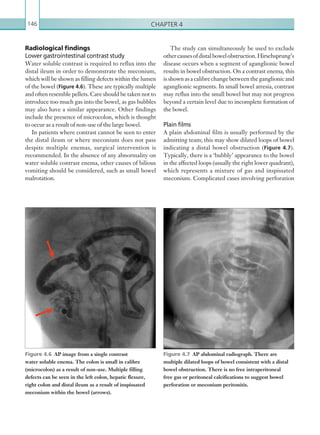 Chapter 4146
The study can simultaneously be used to exclude
othercausesofdistalbowelobstruction.Hirschsprung’s
disease occurs when a segment of aganglionic bowel
results in bowel obstruction. On a contrast enema, this
is shownas acalibrechangebetweentheganglionicand
aganglionic segments. In small bowel atresia, contrast
may reflux into the small bowel but may not progress
beyond a certain level due to incomplete formation of
the bowel.
Plain films
A plain abdominal film is usually performed by the
admitting team; this may show dilated loops of bowel
indicating a distal bowel obstruction (Figure 4.7).
Typically, there is a ‘bubbly’ appearance to the bowel
in the affected loops (usually the right lower quadrant),
which represents a mixture of gas and inspissated
meconium. Complicated cases involving perforation
Radiological findings
Lower gastrointestinal contrast study
Water soluble contrast is required to reflux into the
distal ileum in order to demonstrate the meconium,
which will be shown as filling defects within the lumen
of the bowel (Figure 4.6). These are typically multiple
and often resemble pellets. Care should be taken not to
introduce too much gas into the bowel, as gas bubbles
may also have a similar appearance. Other findings
include the presence of microcolon, which is thought
to occur as a result of non-use of the large bowel.
In patients where contrast cannot be seen to enter
the distal ileum or where meconium does not pass
despite multiple enemas, surgical intervention is
recommended. In the absence of any abnormality on
water soluble contrast enema, other causes of bilious
vomiting should be considered, such as small bowel
malrotation.
Figure 4.6  AP image from a single contrast
water soluble enema. The colon is small in calibre
(microcolon) as a result of non-use. Multiple filling
defects can be seen in the left colon, hepatic flexure,
right colon and distal ileum as a result of inspissated
meconium within the bowel (arrows).
Figure 4.7  AP abdominal radiograph. There are
multiple dilated loops of bowel consistent with a distal
bowel obstruction. There is no free intraperitoneal
free gas or peritoneal calcifications to suggest bowel
perforation or meconium peritonitis.
K22247_C004.indd 146 16/05/15 3:10 AM
 