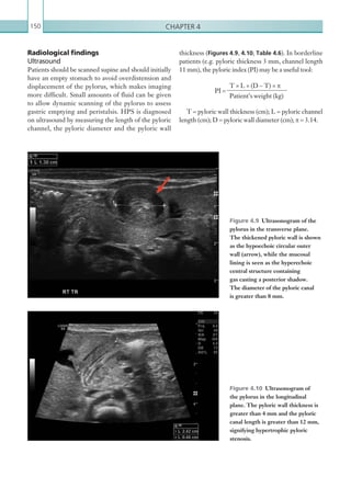 Chapter 4150
Radiological findings
Ultrasound
Patients should be scanned supine and should initially
have an empty stomach to avoid overdistension and
displacement of the pylorus, which makes imaging
more difficult. Small amounts of fluid can be given
to allow dynamic scanning of the pylorus to assess
gastric emptying and peristalsis. HPS is diagnosed
on ultrasound by measuring the length of the pyloric
channel, the pyloric diameter and the pyloric wall
Figure 4.9  Ultrasonogram of the
pylorus in the transverse plane.
The thickened pyloric wall is shown
as the hypoechoic circular outer
wall (arrow), while the mucosal
lining is seen as the hyperechoic
central structure containing
gas casting a posterior shadow.
The diameter of the pyloric canal
is greater than 8 mm.
Figure 4.10  Ultrasonogram of
the pylorus in the longitudinal
plane. The pyloric wall thickness is
greater than 4 mm and the pyloric
canal length is greater than 12 mm,
signifying hypertrophic pyloric
stenosis.
thickness (Figures 4.9, 4.10; Table 4.6). In borderline
patients (e.g. pyloric thickness 3 mm, channel length
11 mm), the pyloric index (PI) may be a useful tool:
PI =
T × L × (D − T) × π
Patient’s weight (kg)
T = pyloric wall thickness (cm); L = pyloric channel
length (cm); D = pyloric wall diameter (cm); π = 3.14.
K22247_C004.indd 150 16/05/15 3:10 AM
 