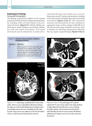 Chapter 4152
Radiological findings
Computed tomography
The findings of periorbital cellulitis on CT imaging
includeperiorbitalsofttissueswellingandinflammatory
fat stranding, which are both limited to the pre-
septal soft tissues (Figure 4.11). Orbital cellulitis may
demonstrate similar findings to periorbital cellulitis,
but with post-septal involvement. Post-septal
involvement may be indicated by an intraconal or
MODALITY PROTOCOL
CT Helical acquisition from the supraorbital ridge
to the base of the maxillary sinuses. 0.625–
1.25 mm slick thickness with sagittal, coronal
and bony algorithm reformatted images. Post
contrast images (e.g. 50 ml Omnipaque 300)
should also be acquired at 90–120 seconds.
Table 4.7  Orbital and periorbital cellulitis.
Imaging protocol.
Figure 4.11  Axial image: unenhanced CT scan of the
orbits. There is a pre-septal fluid collection involving
the right eye with marked inflammatory changes in the
surrounding tissues, but not extending into the orbit.
Locules of gas can be seen adjacent to the lateral orbital
wall as a result of gas forming infection (arrow).
extraconal soft tissue mass (which may or may not
demonstratepost-IVcontrastenhancement),stranding
of the intraconal fat and thickening of the intraorbital
musculature (Figures 4.12a, b). The intraorbital
structures and intraconal fat are best visualised on
appropriate image window settings (width 400, level
40). Post-contrast images should be reviewed in order
to identify any enhancing subperiosteal collections
that may require surgical drainage (Figures 4.13a, b).
Figures 4.12a, b  Coronal images: IV contrast
enhanced CT scans of the orbits in the delayed phase.
A right subperiosteal collection is seen overlying
the right zygoma, with extension into the lateral
orbit abutting the lateral rectus muscle. Ill-defined
inflammatory changes can be seen in the intraconal
fat (arrow).
(a)
( b)
K22247_C004.indd 152 16/05/15 3:10 AM
 