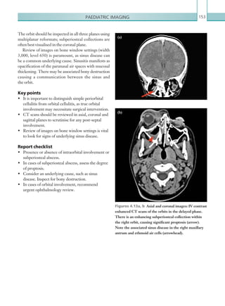 Paediatric imaging 153
The orbit should be inspected in all three planes using
multiplanar reformats; subperiosteal collections are
often best visualised in the coronal plane.
Review of images on bone window settings (width
3,000, level 650) is paramount, as sinus disease can
be a common underlying cause. Sinusitis manifests as
opacification of the paranasal air spaces with mucosal
thickening. There may be associated bony destruction
causing a communication between the sinus and
the orbit.
Key points
•	 It is important to distinguish simple periorbital
cellulitis from orbital cellulitis, as true orbital
involvement may necessitate surgical intervention.
•	 CT scans should be reviewed in axial, coronal and
sagittal planes to scrutinise for any post-septal
involvement.
•	 Review of images on bone window settings is vital
to look for signs of underlying sinus disease.
Report checklist
•	 Presence or absence of intraorbital involvement or
subperiosteal abscess.
•	 In cases of subperiosteal abscess, assess the degree
of proptosis.
•	 Consider an underlying cause, such as sinus
disease. Inspect for bony destruction.
•	 In cases of orbital involvement, recommend
urgent ophthalmology review.
Figures 4.13a, b  Axial and coronal images: IV contrast
enhanced CT scans of the orbits in the delayed phase.
There is an enhancing subperiosteal collection within
the right orbit, causing significant proptosis (arrow).
Note the associated sinus disease in the right maxillary
antrum and ethmoid air cells (arrowhead).
(b)
(a)
K22247_C004.indd 153 16/05/15 3:10 AM
 