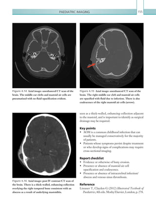Paediatric imaging 155
Figure 4.16  Axial image: post IV contrast CT scan of
the brain. There is a thick-walled, enhancing collection
overlying the right temporal bone consistent with an
abscess as a result of underlying mastoiditis.
Figure 4.15  Axial image: unenhanced CT scan of the
brain. The right middle ear cleft and mastoid air cells
are opacified with fluid due to infection. There is also
coalescence of the right mastoid air cells (arrow).
Figure 4.14  Axial image: unenhanced CT scan of the
brain. The middle ear clefts and mastoid air cells are
pneumatised with no fluid opacification evident.
seen as a thick-walled, enhancing collection adjacent
to the mastoid, and is important to identify as surgical
drainage may be required.
Key points
•	 AOM is a common childhood infection that can
usually be managed conservatively for the majority
of patients.
•	 Patients whose symptoms persist despite treatment
or who develop signs of complications may require
cross-sectional imaging.
Report checklist
•	 Evidence or otherwise of bony erosion.
•	 Presence or absence of mastoid air cell
opacification and coalescence.
•	 Presence or absence of intracerebral infection/
abscess and venous sinus thrombosis.
Reference
Lissauer T, Clayden G (2012) Illustrated Textbook of
Paediatrics,4thedn.MosbyElsevier,London,p. 278.
K22247_C004.indd 155 16/05/15 3:10 AM
 