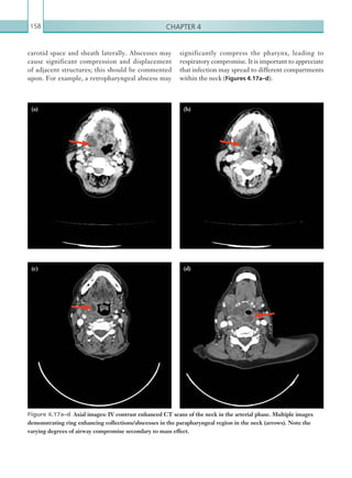 Chapter 4158
significantly compress the pharynx, leading to
respiratory compromise. It is important to appreciate
that infection may spread to different compartments
within the neck (Figures 4.17a–d).
carotid space and sheath laterally. Abscesses may
cause significant compression and displacement
of adjacent structures; this should be commented
upon. For example, a retropharyngeal abscess may
Figure 4.17a–d  Axial images: IV contrast enhanced CT scans of the neck in the arterial phase. Multiple images
demonstrating ring enhancing collections/abscesses in the parapharyngeal region in the neck (arrows). Note the
varying degrees of airway compromise secondary to mass effect.
(a) (b)
(c) (d)
K22247_C004.indd 158 16/05/15 3:10 AM
 