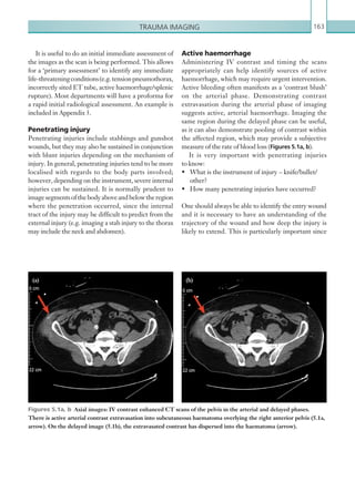 Trauma imaging 163
Active haemorrhage
Administering IV contrast and timing the scans
appropriately can help identify sources of active
haemorrhage, which may require urgent intervention.
Active bleeding often manifests as a ‘contrast blush’
on the arterial phase. Demonstrating contrast
extravasation during the arterial phase of imaging
suggests active, arterial haemorrhage. Imaging the
same region during the delayed phase can be useful,
as it can also demonstrate pooling of contrast within
the affected region, which may provide a subjective
measure of the rate of blood loss (Figures 5.1a, b).
It is very important with penetrating injuries
to know:
•	 What is the instrument of injury – knife/bullet/
other?
•	 How many penetrating injuries have occurred?
One should always be able to identify the entry wound
and it is necessary to have an understanding of the
trajectory of the wound and how deep the injury is
likely to extend. This is particularly important since
It is useful to do an initial immediate assessment of
the images as the scan is being performed. This allows
for a ‘primary assessment’ to identify any immediate
life-threateningconditions(e.g.tensionpneumothorax,
incorrectly sited ET tube, active haemorrhage/splenic
rupture). Most departments will have a proforma for
a rapid initial radiological assessment. An example is
included in Appendix 3.
Penetrating injury
Penetrating injuries include stabbings and gunshot
wounds, but they may also be sustained in conjunction
with blunt injuries depending on the mechanism of
injury. In general, penetrating injuries tend to be more
localised with regards to the body parts involved;
however, depending on the instrument, severe internal
injuries can be sustained. It is normally prudent to
imagesegmentsofthebodyaboveandbelowtheregion
where the penetration occurred, since the internal
tract of the injury may be difficult to predict from the
external injury (e.g. imaging a stab injury to the thorax
may include the neck and abdomen).
Figures 5.1a, b  Axial images: IV contrast enhanced CT scans of the pelvis in the arterial and delayed phases.
There is active arterial contrast extravasation into subcutaneous haematoma overlying the right anterior pelvis (5.1a,
arrow). On the delayed image (5.1b), the extravasated contrast has dispersed into the haematoma (arrow).
(a) (b)
K22247_C005.indd 163 16/05/15 3:11 AM
 
