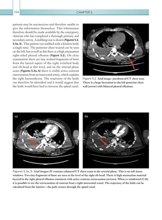 Chapter 5164
patients may be unconscious and therefore unable to
give the information themselves. This information
therefore should be made available by the emergency
clinician who has completed a thorough primary and
secondarysurvey.Astabbingcaseisshown(Figures 5.2,
5.3a, b). This patient was stabbed with a kitchen knife
a single time. The posterior chest wound can be seen
on the left, but as well as this there is a high attenuation
right-sided pleural effusion (Figure 5.2). On close
examination there are tiny avulsed fragments of bone
from the lateral aspect of the right vertebral body
and rib head at this level, and on the arterial phase
scans (Figures 5.3a, b) there is visible active contrast
extravasation from an intercostal artery, which explains
the right haemothorax. The trajectory of the knife
can therefore be identified and it would suggest that
the knife would have had to traverse the spinal canal.
Figure 5.2  Axial image: unenhanced CT chest scan.
There is a large laceration to the left posterior chest
wall (arrow) with bilateral pleural effusions.
Figures 5.3a, b  Axial images: IV contrast enhanced CT chest scans in the arterial phase. This is on soft tissue
windows. Two tiny fragments of bone are seen at the level of the right rib head. There is high attenuation material
layered in the right pleural effusion consistent with active contrast extravasation (arrows). When re-windowed (5.3b)
it is possible to see the extravasation of contrast from a right intercostal vessel. The trajectory of the knife can be
calculated from the injuries – the path crosses through the spinal canal.
(a) (b)
K22247_C005.indd 164 16/05/15 3:11 AM
 