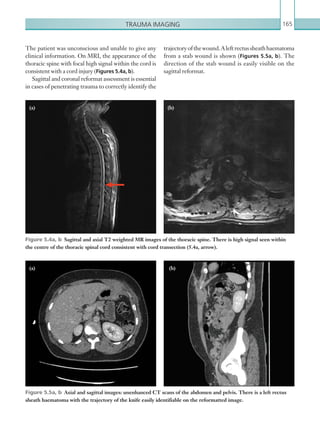 Trauma imaging 165
trajectoryofthewound.Aleftrectussheathhaematoma
from a stab wound is shown (Figures 5.5a, b). The
direction of the stab wound is easily visible on the
sagittal reformat.
The patient was unconscious and unable to give any
clinical information. On MRI, the appearance of the
thoracic spine with focal high signal within the cord is
consistent with a cord injury (Figures 5.4a, b).
Sagittal and coronal reformat assessment is essential
in cases of penetrating trauma to correctly identify the
Figure 5.4a, b  Sagittal and axial T2 weighted MR images of the thoracic spine. There is high signal seen within
the centre of the thoracic spinal cord consistent with cord transection (5.4a, arrow).
(a) (b)
Figure 5.5a, b  Axial and sagittal images: unenhanced CT scans of the abdomen and pelvis. There is a left rectus
sheath haematoma with the trajectory of the knife easily identifiable on the reformatted image.
(a) (b)
K22247_C005.indd 165 16/05/15 3:11 AM
 