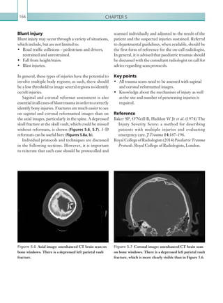 Chapter 5166
Blunt injury
Blunt injury may occur through a variety of situations,
which include, but are not limited to:
•	 Road traffic collisions – pedestrians and drivers,
restrained and unrestrained.
•	 Fall from height/stairs.
•	 Blast injuries.
In general, these types of injuries have the potential to
involve multiple body regions; as such, there should
be a low threshold to image several regions to identify
occult injuries.
Sagittal and coronal reformat assessment is also
essentialinallcasesofblunttraumainordertocorrectly
identify bony injuries. Fractures are much easier to see
on sagittal and coronal reformatted images than on
the axial images, particularly in the spine. A depressed
skull fracture at the skull vault, which could be missed
without reformats, is shown (Figures 5.6, 5.7). 3-D
reformats can be useful here (Figures 5.8a, b).
Individual protocols and techniques are discussed
in the following sections. However, it is important
to reiterate that each case should be protocolled and
Figure 5.6  Axial image: unenhanced CT brain scan on
bone windows. There is a depressed left parietal vault
fracture.
Figure 5.7  Coronal image: unenhanced CT brain scan
on bone windows. There is a depressed left parietal vault
fracture, which is more clearly visible than in Figure 5.6.
scanned individually and adjusted to the needs of the
patient and the suspected injuries sustained. Referral
to departmental guidelines, when available, should be
the first form of reference for the on-call radiologist.
In general, it is advised that paediatric traumas should
be discussed with the consultant radiologist on call for
advice regarding scan protocols.
Key points
•	 All trauma scans need to be assessed with sagittal
and coronal reformatted images.
•	 Knowledge about the mechanism of injury as well
as the site and number of penetrating injuries is
required.
Reference
Baker SP, O’Neill B, Haddon W Jr et al. (1974) The
Injury Severity Score: a method for describing
patients with multiple injuries and evaluating
emergency care. J Trauma 14:187–196.
RoyalCollegeofRadiologists(2014)Paediatric Trauma
Protocols. Royal College of Radiologists, London.
K22247_C005.indd 166 16/05/15 3:11 AM
 
