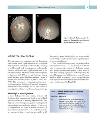 Trauma imaging 167
MAJOR TRAUMA: THORAX
Thoracic trauma can result in severe, life-threatening
injuries that need rapid diagnosis and treatment.
The myriad of pathology can be variable, resulting
in problems with both respiratory and cardiovascular
function and leading to a rapid deterioration in the
patient’s condition. Mortality rates have been reported
in the region of 10–15% as a result of thoracic trauma,
which is second only to head injuries in the context of
major trauma patients (Shorr et al., 1987; Kaewlai et al.,
2008). The mechanism of injury, clinical parameters
and examination findings all provide important
information to the radiologist and can often be used to
predictpatternsofinjuryandtheunderlyingpathology.
Radiological investigations
In most dedicated trauma centres, patients with
significant chest trauma should ideally be assessed with
contrast enhanced CT. Not only does this allow a rapid
diagnosis of any acute pathology that may be present,
it also assists in ascertaining the adequacy of placement
of support lines and tubes. Contrast enhanced CT
gives an accurate depiction of the aorta to assess for
any acute aortic injury, which may potentially be life
MODALITY PROTOCOL
CT Arterial phase: 100 ml IV contrast via 18G
cannula, 4 ml/sec. Bolus track centred on the
aortic arch. Scan from the thoracic inlet to
the inferior border of liver. Slice thickness of
0.625–1.25 mm to allow accurate multiplanar
reformats of the images.
Table 5.1  Major trauma: thorax. Imaging
­protocol.
Figures 5.8a, b  Reformatted 3-D
images of the vault fracture (arrows)
shown in Figures 5.6 and 5.7.
(a) (b)
threatening. It can also highlight any acute arterial
haemorrhage, which may necessitate urgent surgical
or interventional input.
Chest plain film imaging may be performed in
some centres where CT is not readily available or
prior to transferring a patient to a dedicated trauma
unit. Although gross pathology may be seen on chest
plain film imaging, significant pathologies may be
missed. Images are inevitably acquired in an AP supine
position, which may obscure important pathologies
such as pneumothorax and haemothorax in addition to
great vessel injuries. (See Table 5.1.)
K22247_C005.indd 167 16/05/15 3:11 AM
 