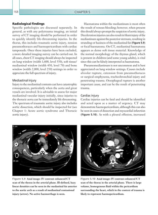Chapter 5168
Haematoma within the mediastinum is most often
the result of venous bleeding; however, when present
thisshouldalwayspromptthesuspicionofaorticinjury.
Decelerationinjuriescanalsoresultinbluntinjuryofthe
mediastinumagainsttheposteriorsternum,resultingin
stranding or haziness of the mediastinal fat (Figure 5.9)
or focal haematoma. On CT, mediastinal haematoma
appears as dense soft tissue material. Knowledge of
the normal morphology of the thymus gland, which
is present in children (and some young adults), is vital
since this can be falsely interpreted as haematoma.
Pneumomediastinum is not uncommon and is best
appreciated on lung window settings. Causes include
alveolar rupture, extension from pneumothoraces
or surgical emphysema, tracheobronchial injury and
penetrating trauma. Oesophageal rupture is another
important cause, and can be the result of penetrating
trauma.
Cardiac injury
Cardiac injuries can be fatal and should be identified
and acted upon as a matter of urgency. CT may
demonstrate haemopericardium, although this can also
be seen in cases of dissection and myocardial infarction
(Figure 5.10). As with a pleural effusion, increased
Radiological findings
Specific pathologies are discussed separately. In
general, as with any polytrauma imaging, an initial
survey of CT imaging should be performed in order
to quickly identify life-threatening injuries. In the
thorax, this includes traumatic aortic injury, tension
pneumothoraces and haemopericardium with cardiac
tamponade. Once these injuries have been excluded,
a more detailed imaging survey can be carried out. In
all cases, chest CT imaging should always be inspected
on lung window (width 1,600, level 550), soft tissue/
mediastinal window (width 450, level 70) and bone
window (width 2,000, level 250) settings in order to
appreciate the full spectrum of injury.
Mediastinal injury
Injurytothemediastinalcontentscanhavecatastrophic
consequences, particularly when the aorta and great
vessels are involved. It is advisable to assess for major
mediastinal vascular injury initially, since injuries to
the thoracic aorta can be immediately life threatening.
The spectrum of traumatic aortic injury also includes
aortic dissection, which should be inspected for (see
Chapter 1: Acute aortic syndrome and Thoracic
aortic injury).
Figure 5.9  Axial image: IV contrast enhanced CT
scan of the thorax in the arterial phase. Ill-defined, hazy
linear densities can be seen in the medastinal fat anterior
to the aortic arch as a result of mediastinal contusional
injury (arrow). No active haemorrhage is seen.
Figure 5.10  Axial image: IV contrast enhanced CT
scan of the thorax in the arterial phase. There is large
volume, homogenous fluid within the pericardium
surrounding the heart, which in the context of trauma is
likely to represent haemopericardium.
K22247_C005.indd 168 16/05/15 3:11 AM
 