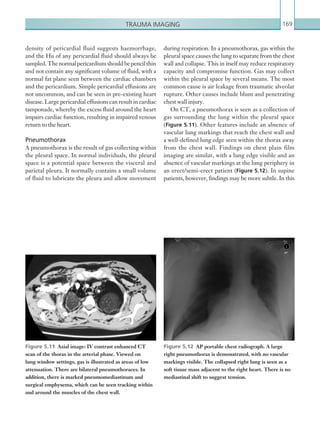 Trauma imaging 169
during respiration. In a pneumothorax, gas within the
pleural space causes the lung to separate from the chest
wall and collapse. This in itself may reduce respiratory
capacity and compromise function. Gas may collect
within the pleural space by several means. The most
common cause is air leakage from traumatic alveolar
rupture. Other causes include blunt and penetrating
chest wall injury.
On CT, a pneumothorax is seen as a collection of
gas surrounding the lung within the pleural space
(Figure 5.11). Other features include an absence of
vascular lung markings that reach the chest wall and
a well-defined lung edge seen within the thorax away
from the chest wall. Findings on chest plain film
imaging are similar, with a lung edge visible and an
absence of vascular markings at the lung periphery in
an erect/semi-erect patient (Figure 5.12). In supine
patients, however, findings may be more subtle. In this
density of pericardial fluid suggests haemorrhage,
and the Hu of any pericardial fluid should always be
sampled.Thenormalpericardiumshouldbepencilthin
and not contain any significant volume of fluid, with a
normal fat plane seen between the cardiac chambers
and the pericardium. Simple pericardial effusions are
not uncommon, and can be seen in pre-existing heart
disease. Large pericardial effusions can result in cardiac
tamponade, whereby the excess fluid around the heart
impairs cardiac function, resulting in impaired venous
return to the heart.
Pneumothorax
A pneumothorax is the result of gas collecting within
the pleural space. In normal individuals, the pleural
space is a potential space between the visceral and
parietal pleura. It normally contains a small volume
of fluid to lubricate the pleura and allow movement
Figure 5.11  Axial image: IV contrast enhanced CT
scan of the thorax in the arterial phase. Viewed on
lung window settings, gas is illustrated as areas of low
attenuation. There are bilateral pneumothoraces. In
addition, there is marked pneumomediastinum and
surgical emphysema, which can be seen tracking within
and around the muscles of the chest wall.
Figure 5.12  AP portable chest radiograph. A large
right pneumothorax is demonstrated, with no vascular
markings visible. The collapsed right lung is seen as a
soft tissue mass adjacent to the right heart. There is no
mediastinal shift to suggest tension.
K22247_C005.indd 169 16/05/15 3:11 AM
 