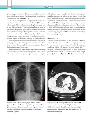 Chapter 5170
defect in the pleura (e.g. broken rib) and through the
fascial planes into the subcutaneous tissues. It may also
occurasaresultofdirectpenetratinginjurytothechest,
resultinginatractbetweenthesubcutaneoustissuesand
the outside. On imaging, this is seen as gas overlying
the chest within the subcutaneous tissues. This is often
a fairly self-limiting condition with treatment aimed
at the underlying pneumothorax. However, it may
occasionally progress and become extensive resulting
in airway compromise.
Haemothorax
Haemothorax is defined as the presence of blood
within the pleural space. The underlying cause may
be any cause of haemorrhage within the thorax, such
as pleural injury, rib fracture or lung injury. On CT
imaging, haemothoraces appear as fluid within the
pleural spaces, which is usually denser than simple
pleural effusions (Figure 5.14). It should be noted
position, gas collects in the most dependent position
(anteroinferiorly against the diaphragm), appearing as
a deep sulcus sign (Figure 5.13).
The main complication of a pneumothorax is the
development of a tension pneumothorax. This occurs
when gas is able to collect within the pleural space but
is not able to escape. This results in a large volume of
gas within the pleural space, which exerts considerable
masseffect,resulting in shifting of mediastinalcontents
to the contralateral side. The mass effect of this raises
the pressure within the thorax and compromises
venous return to the heart, leading to cardiac failure.
A tension pneumothorax ideally should not be seen on
imaging as it is a clinical diagnosis requiring immediate
intervention.However,ifitisseenonimaging,itshould
be immediately decompressed.
Pneumothoraces in the context of chest trauma may
also result in subcutaneous emphysema. This occurs
when gas within the pleural space tracks through a
Figure 5.14  Axial image: IV contrast enhanced CT
scan of the thorax in the arterial phase. Dependent
fluid can be seen in the right pleural space. A right
pneumothorax is also seen, and this is therefore a
pneumohaemothorax.
Figure 5.13  AP chest radiograph. There is a left
pneumothorax. In the supine position, gas within the
pleural space collects within the most superior part of
the thorax, which is the costophrenic recess antero-
inferiorly (arrow).
K22247_C005.indd 170 16/05/15 3:11 AM
 