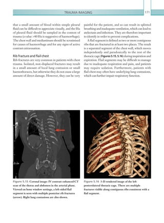 Trauma imaging 171
painful for the patient, and so can result in splinted
breathing and inadequate ventilation, which can lead to
atelectasis and infection. They are therefore important
to identify in order to prevent complications.
A flail segment is defined as two or more contiguous
ribs that are fractured in at least two places. The result
is a separated segment of the chest wall, which moves
independently and paradoxically to the rest of the
thoraciccage(Figures5.15,5.16)duringinspirationand
expiration. Flail segments may be difficult to manage
due to inadequate respiration and pain, and patients
may require sedation. Furthermore, patients with
flail chest may often have underlying lung contusions,
which can further impair respiratory function.
that a small amount of blood within simple pleural
fluid can be difficult to appreciate visually, and the Hu
of pleural fluid should be sampled in the context of
trauma (a value 40 Hu is suggestive of haemorrhage).
The chest wall and mediastinum should be scrutinised
for causes of haemorrhage and for any signs of active
contrast extravasation.
Rib fracture and flail chest
Rib fractures are very common in patients with chest
trauma. Isolated, non-displaced fractures may result
in a small amount of local lung contusion or small
haemothoraces, but otherwise they do not cause a large
amount of direct damage. However, they can be very
Figure 5.15  Coronal image: IV contrast enhanced CT
scan of the thorax and abdomen in the arterial phase.
Viewed on bone window settings, a left-sided flail
segment is seen with multiple posterior rib fractures
(arrow). Right lung contusions are also shown.
Figure 5.16  3-D rendered image of the left
posterolateral thoracic cage. There are multiple
fractures visible along contiguous ribs consistent with a
flail segment.
K22247_C005.indd 171 16/05/15 3:11 AM
 