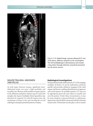 Trauma imaging 173
MAJOR TRAUMA: ABDOMEN
AND PELVIS
As with major thoracic trauma, significant intra-
abdominal injury can carry a high morbidity and
mortality rate. Because of the number of organ systems
in the abdomen and pelvis, injuries may be varied and
complex; the input of multiple clinical specialties may
therefore be required. As with all trauma cases, the
mechanism of injury is key and can help the on-call
radiologist anticipate potential patterns of injury.
Figure 5.18  Sagittal image: contrast enhanced CT scan
of the thorax, abdomen and pelvis in the arterial phase.
The left hemidiaphragm is discontinuous and contains
a large defect through which the stomach has herniated
into the thorax (arrow).
Radiological investigations
Inhaemodynamicallystablepatients,CTistheimaging
modality of choice. It can be undertaken relatively
quickly and provides definitive imaging of the solid
organs and bowel, enabling identification of apparent
and occult injuries. In unstable patients, CT may not
be appropriate given the time taken to transfer and
scan the patient. Under these circumstances, it may
be more prudent to proceed directly to exploratory
laparotomy; this should be discussed with the referring
trauma team. Ultrasound can also play a role in trauma
K22247_C005.indd 173 16/05/15 3:11 AM
 