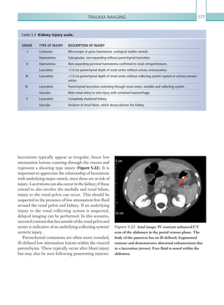 Trauma imaging 177
lacerations typically appear as irregular, linear low
attenuation lesions coursing through the viscera and
represent a shearing type injury (Figure 5.22). It is
important to appreciate the relationship of lacerations
with underlying major vessels, since these are at risk of
injury. Lacerations can also occur in the kidney; if these
extend to also involve the medulla and renal hilum,
injury to the renal pelvis can occur. This should be
suspected in the presence of low attenuation free fluid
around the renal pelvis and kidney. If an underlying
injury to the renal collecting system is suspected,
delayed imaging can be performed. In this scenario,
excretedcontrastthatliesoutsideoftherenalpelvisand
ureter is indicative of an underlying collecting system/
ureteric injury.
Parenchymal contusions are often more rounded,
ill-defined low attenuation lesions within the visceral
parenchyma. These typically occur after blunt injury
but may also be seen following penetrating injuries.
GRADE TYPE OF INJURY DESCRIPTION OF INJURY
I Contusion Microscopic or gross haematuria, urological studies normal.
Haematoma Subcapsular, non-expanding without parenchymal laceration.
II Haematoma Non-expanding perirenal haematoma confirmed to renal retroperitoneum.
Laceration 1.0 cm parenchymal depth of renal cortex without urinary extravasation.
III Laceration 1.0 cm parenchymal depth of renal cortex without collecting system rupture or urinary extrava-
sation.
IV Laceration Parenchymal laceration extending through renal cortex, medulla and collecting system.
Vascular Main renal artery or vein injury with contained haemorrhage.
V Laceration Completely shattered kidney.
Vascular Avulsion of renal hilum, which devascularises the kidney.
Table 5.5  Kidney injury scale.
Figure 5.22  Axial image: IV contrast enhanced CT
scan of the abdomen in the portal venous phase. The
body of the pancreas has an ill-defined, fragmented
contour and demonstrates abnormal enhancement due
to a laceration (arrow). Free fluid is noted within the
abdomen.
K22247_C005.indd 177 16/05/15 3:11 AM
 