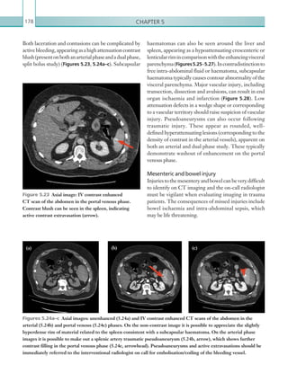 Chapter 5178
Both laceration and contusions can be complicated by
activebleeding,appearingasahighattenuationcontrast
blush(presentonbothanarterialphaseandadualphase,
split bolus study) (Figures 5.23, 5.24a–c). Subcapsular
Figure 5.23  Axial image: IV contrast enhanced
CT scan of the abdomen in the portal venous phase.
Contrast blush can be seen in the spleen, indicating
active contrast extravasation (arrow).
Figures 5.24a–c  Axial images: unenhanced (5.24a) and IV contrast enhanced CT scans of the abdomen in the
arterial (5.24b) and portal venous (5.24c) phases. On the non-contrast image it is possible to appreciate the slightly
hyperdense rim of material related to the spleen consistent with a subcapsular haematoma. On the arterial phase
images it is possible to make out a splenic artery traumatic pseudoaneurysm (5.24b, arrow), which shows further
contrast filling in the portal venous phase (5.24c, arrowhead). Pseudoaneurysms and active extravasations should be
immediately referred to the interventional radiologist on call for embolisation/coiling of the bleeding vessel.
haematomas can also be seen around the liver and
spleen, appearing as a hypoattenuating crescenteric or
lenticularrimincomparisonwiththeenhancingvisceral
parenchyma(Figures5.25–5.27).Incontradistinctionto
free intra-abdominal fluid or haematoma, subcapsular
haematoma typically causes contour abnormality of the
visceral parenchyma. Major vascular injury, including
transection, dissection and avulsions, can result in end
organ ischaemia and infarction (Figure 5.28). Low
attenuation defects in a wedge shape or corresponding
to a vascular territory should raise suspicion of vascular
injury. Pseudoaneurysms can also occur following
traumatic injury. These appear as rounded, well-
defined hyperattenuating lesions (corresponding to the
density of contrast in the arterial vessels), apparent on
both an arterial and dual phase study. These typically
demonstrate washout of enhancement on the portal
venous phase.
Mesenteric and bowel injury
Injuriestothemesenteryandbowelcanbeverydifficult
to identify on CT imaging and the on-call radiologist
must be vigilant when evaluating imaging in trauma
patients. The consequences of missed injuries include
bowel ischaemia and intra-abdominal sepsis, which
may be life threatening.
(a) (b) (c)
K22247_C005.indd 178 16/05/15 3:11 AM
 