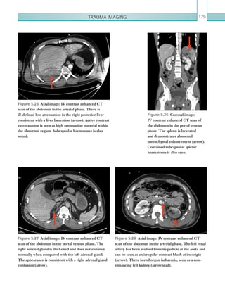 Trauma imaging 179
Figure 5.25  Axial image: IV contrast enhanced CT
scan of the abdomen in the arterial phase. There is
ill-defined low attenuation in the right posterior liver
consistent with a liver laceration (arrow). Active contrast
extravasation is seen as high attenuation material within
the abnormal region. Subcapsular haematoma is also
noted.
Figure 5.26  Coronal image:
IV contrast enhanced CT scan of
the abdomen in the portal venous
phase. The spleen is lacerated
and demonstrates abnormal
parenchymal enhancement (arrow).
Contained subcapsular splenic
haematoma is also seen.
Figure 5.27  Axial image: IV contrast enhanced CT
scan of the abdomen in the portal venous phase. The
right adrenal gland is thickened and does not enhance
normally when compared with the left adrenal gland.
The appearance is consistent with a right adrenal gland
contusion (arrow).
Figure 5.28  Axial image: IV contrast enhanced CT
scan of the abdomen in the arterial phase. The left renal
artery has been avulsed from its pedicle at the aorta and
can be seen as an irregular contrast blush at its origin
(arrow). There is end organ ischaemia, seen as a non-
enhancing left kidney (arrowhead).
K22247_C005.indd 179 16/05/15 3:11 AM
 