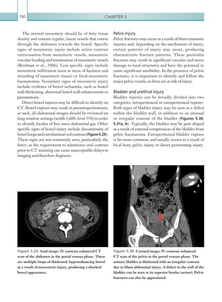 Chapter 5180
Pelvic injury
Pelvic fractures may occur as a result of blunt traumatic
injuries and, depending on the mechanism of injury,
certain patterns of injury may occur, producing
characteristic fracture patterns. These particular
fractures may result in significant vascular and nerve
damage to local structures and have the potential to
cause significant morbidity. In the presence of pelvic
fractures, it is important to identify and follow the
major pelvic vessels, as these are at risk of injury.
Bladder and urethral injury
Bladder injuries can be broadly divided into two
categories: intraperitoneal or extraperitoneal rupture.
Both types of bladder injury may be seen as a defect
within the bladder wall, in addition to an unusual
or irregular contour of the bladder (Figures 5.30,
5.31a, b). Typically, the bladder may be pear shaped
as a result of external compression of the bladder from
pelvic haematoma. Extraperitoneal bladder rupture
is far more common, and usually occurs as a result of
local bony pelvic injury or direct penetrating injury.
The normal mesentery should be of fatty tissue
density and contain regular, linear vessels that course
through the abdomen towards the bowel. Specific
signs of mesenteric injury include active contrast
extravasation from mesenteric vessels, mesenteric
vascular beading and termination of mesenteric vessels
(Brofman et al., 2006). Less specific signs include
mesenteric infiltration (seen as areas of haziness and
stranding of mesenteric tissue) or focal mesenteric
haematomas. Secondary signs of mesenteric injury
include evidence of bowel ischaemia, such as bowel
wall thickening, abnormal bowel wall enhancement or
pneumatosis.
Direct bowel injuries may be difficult to identify on
CT. Bowel rupture may result in pneumoperitoneum;
as such, all abdominal images should be reviewed on
lung window settings (width 1,600, level 550) in order
to identify locules of free intra-abdominal gas. Other
specific signs of bowel injury include discontinuity of
bowelloopsandextraluminaloralcontrast(Figure 5.29).
These signs are not commonly seen, particularly the
latter, as the requirement to administer oral contrast
prior to CT scanning can cause unacceptable delays in
imaging and therefore diagnosis.
Figure 5.30  Coronal image: IV contrast enhanced
CT scan of the pelvis in the portal venous phase. The
urinary bladder is thickened with an irregular contour
due to blunt abdominal injury. A defect in the wall of the
bladder can be seen at its superior border (arrow). Pelvic
fractures can also be appreciated.
Figure 5.29  Axial image: IV contrast enhanced CT
scan of the abdomen in the portal venous phase. There
are multiple loops of thickened, hyperenhancing bowel
as a result of mesenteric injury, producing a shocked
bowel appearance.
K22247_C005.indd 180 16/05/15 3:11 AM
 