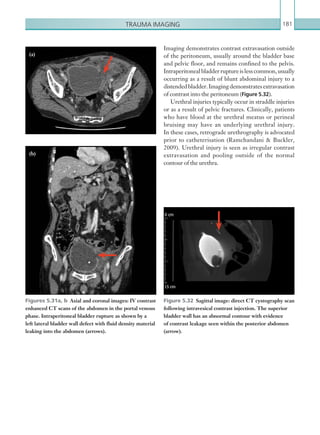 Trauma imaging 181
Figures 5.31a, b  Axial and coronal images: IV contrast
enhanced CT scans of the abdomen in the portal venous
phase. Intraperitoneal bladder rupture as shown by a
left lateral bladder wall defect with fluid density material
leaking into the abdomen (arrows).
Figure 5.32  Sagittal image: direct CT cystography scan
following intravesical contrast injection. The superior
bladder wall has an abnormal contour with evidence
of contrast leakage seen within the posterior abdomen
(arrow).
Imaging demonstrates contrast extravasation outside
of the peritoneum, usually around the bladder base
and pelvic floor, and remains confined to the pelvis.
Intraperitonealbladderruptureislesscommon,usually
occurring as a result of blunt abdominal injury to a
distendedbladder.Imagingdemonstratesextravasation
of contrast into the peritoneum (Figure 5.32).
Urethral injuries typically occur in straddle injuries
or as a result of pelvic fractures. Clinically, patients
who have blood at the urethral meatus or perineal
bruising may have an underlying urethral injury.
In these cases, retrograde urethrography is advocated
prior to catheterisation (Ramchandani  Buckler,
2009). Urethral injury is seen as irregular contrast
extravasation and pooling outside of the normal
contour of the urethra.
(a)
(b)
K22247_C005.indd 181 16/05/15 3:11 AM
 