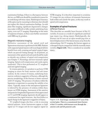 Trauma imaging 185
STIR imaging. It is therefore important to scrutinise
T1 images for any evidence of traumatic haematoma
both within and outside the spine, as this may result in
spinal cord compression.
Examples of spinal fractures
Jefferson fracture
This describes an unstable burst fracture of the C1
vertebra. It occurs as a result of a significant axial load
type injury (e.g. diving injury). Radiologically, the
fracture can be seen on an open-mouth peg view as
lateral displacement of the lateral masses away from the
odontoid peg. On CT imaging, the fracture appears as
a disrupted ring in comparison with the normally intact
vertebra (Figure 5.35). This is considered an unstable
injury.
examination findings; if there is a discrepancy between
the two, an MRI scan should be considered to assess for
an underlying soft tissue injury. Radiological clearance
ofthespinemaybereassuringtoclinicians,butitshould
not replace the clinical examination findings. As with
plain film imaging, significant degenerative changes
may make it difficult to fully exclude underlying bony
injury, even on CT imaging. Depending on the index
of suspicion of injury, in these cases further assessment
with MRI may by prudent.
Magnetic resonance imaging
Definitive assessment of the spinal cord and
ligamentousstructuresisperformedwithMRI.Patients
with suspected spinal injuries with neurological deficits
benefit from early scanning and spinal surgical input,
which can prevent lasting damage. In all patients, an
assessment of the spinal cord and canal should be made
to identify any evidence of spinal cord compression
(see Chapter 3: Neurology and non-traumatic spinal
imaging, Spinal cord compression and cauda equina
syndrome). This is best performed on T2 weighted
axial and sagittal imaging.
In trauma patients, it is prudent to perform STIR
imaging to assess for bone marrow and soft tissue
oedema. In the context of trauma, underlying bone
marrow oedema is suggestive of fracture, although the
precise morphology of the fracture is better assessed
with CT imaging. The presence of oedema within the
ligaments is important in assessing the stability of an
injury. Typically, injury to the interspinous ligaments
is inferred by the presence of oedema within these
tissues on STIR imaging. Assessment of the anterior
andposteriorlongitudinalligamentsisbestappreciated
on T2 and STIR imaging; ligaments should appear as
a continuous low signal structure. Any focal defect or
signal change in the ligament is suggestive of injury.
T1 weighted images also have a role in assessing
injured patients. Acute haematoma appear as high
signal on T1 images and do not suppress signal on
Figure 5.35  Axial image: unenhanced CT scan of the
cervical spine. There is a comminuted, burst fracture
of the C1 vertebra, with fractures seen through the
anterior arch and left posterior arch.
K22247_C005.indd 185 16/05/15 3:11 AM
 
