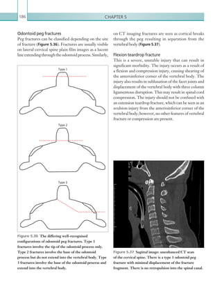 Chapter 5186
Odontoid peg fractures
Peg fractures can be classified depending on the site
of fracture (Figure 5.36). Fractures are usually visible
on lateral cervical spine plain film images as a lucent
lineextendingthroughtheodontoidprocess.Similarly,
Figure 5.37  Sagittal image: unenhanced CT scan
of the cervical spine. There is a type 1 odontoid peg
fracture with minimal displacement of the fracture
fragment. There is no retropulsion into the spinal canal.
Figure 5.36  The differing well-recognised
configurations of odontoid peg fractures. Type 1
fractures involve the tip of the odontoid process only.
Type 2 fractures involve the base of the odontoid
process but do not extend into the vertebral body. Type
3 fractures involve the base of the odontoid process and
extend into the vertebral body.
on CT imaging fractures are seen as cortical breaks
through the peg resulting in separation from the
vertebral body (Figure 5.37).
Flexion teardrop fracture
This is a severe, unstable injury that can result in
significant morbidity. The injury occurs as a result of
a flexion and compression injury, causing shearing of
the anteroinferior corner of the vertebral body. The
injury also results in subluxation of the facet joints and
displacement of the vertebral body with three column
ligamentous disruption. This may result in spinal cord
compression. The injury should not be confused with
an extension teardrop fracture, which can be seen as an
avulsion injury from the anterioinferior corner of the
vertebral body; however, no other features of vertebral
fracture or compression are present.
Type 1
Type 2
Type 3
K22247_C005.indd 186 16/05/15 3:11 AM
 