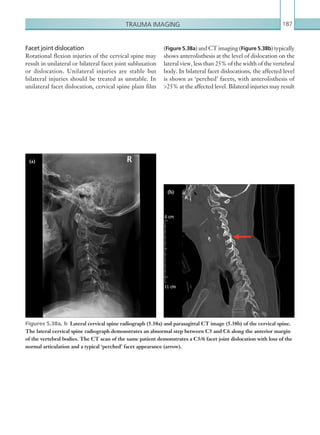 Trauma imaging 187
(Figure 5.38a) and CT imaging (Figure 5.38b) typically
shows anterolisthesis at the level of dislocation on the
lateral view, less than 25% of the width of the vertebral
body. In bilateral facet dislocations, the affected level
is shown as ‘perched’ facets, with anterolisthesis of
25% at the affected level. Bilateral injuries may result
Facet joint dislocation
Rotational flexion injuries of the cervical spine may
result in unilateral or bilateral facet joint subluxation
or dislocation. Unilateral injuries are stable but
bilateral injuries should be treated as unstable. In
unilateral facet dislocation, cervical spine plain film
Figures 5.38a, b  Lateral cervical spine radiograph (5.38a) and parasagittal CT image (5.38b) of the cervical spine.
The lateral cervical spine radiograph demonstrates an abnormal step between C5 and C6 along the anterior margin
of the vertebral bodies. The CT scan of the same patient demonstrates a C5/6 facet joint dislocation with loss of the
normal articulation and a typical ‘perched’ facet appearance (arrow).
(a)
(b)
K22247_C005.indd 187 16/05/15 3:11 AM
 
