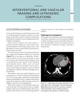 191
Chapter 6
INTERVENTIONAL AND ­VASCULAR
IMAGING AND IATROGENIC
­COMPLICATIONS
ACUTE ARTERIAL ISCHAEMIA
Acute arterial occlusion in an extremity must be treated
as a medical/surgical emergency as there is not only
danger to the limb, but also to the life of the patient.
Generally this condition occurs in elderly patients with
multiple comorbidities.
Acute arterial occlusion can be the result of a
proximal embolus lodging in a more distal vessel,
acute thrombosis of a previously patent artery, acute
thrombosis of a stent or graft, dissection of an artery or
direct trauma to an artery.
The most common source of embolism is the heart;
for example, from thrombus within an LV aneurysm
(Figure 6.1) or secondary to arrhythmias. Arterio-
arterial emboli can arise from aneurysms or from
non-occlusive, ulcerated atheromatous plaques. Acute
in-situ thrombosis occurs mostly at sites of stenotic
arteriosclerotic lesions. Other causes of arterial
thrombosis include ­pro-thrombotic states such as
recent trauma/surgery, pregnancy, cancer, reversal of
anticoagulation,nephroticsyndromeandinflammatory
bowel disease.
Presentation with acute arterial ischaemia is most
commonly seen in the lower limbs and characterised
by ‘the 6 P’s: pain, pallor, pulselessness, paraesthesia,
paralysisandpoikilothermia(i.e.coldness).Paraesthesia
and paralysis imply irreversible ischaemia, and muscle
rigidity is a sign of a non-salvageable limb.
With acute occlusion of central blood vessels such
as the aorta, iliac or femoral arteries, there is complete
ischaemia with onset of rhabdomyolysis after four to
six hours; this can lead to severe local and generalised
symptoms because of the dangerous metabolites
released.
Radiological investigations
Ultrasoundcanbeusedfortheassessmentofperipheral
arterial flow, especially in the arms and legs. Doppler
or duplex scanning can assess arterial flow patterns to
assess for thrombosis. In the acute setting, however,
the availability of expertise in duplex scanning is
relatively rare.
Figure 6.1  Axial image: IV contrast enhanced CT scan
of the chest in the arterial phase. The non-enhancing
filling defect (arrow) in the left ventricle is ­consistent
with LV thrombus. There is thinning of the LV
­myocardium at the apex due to a previous infarct.
K22247_C006.indd 191 16/05/15 3:12 AM
 
