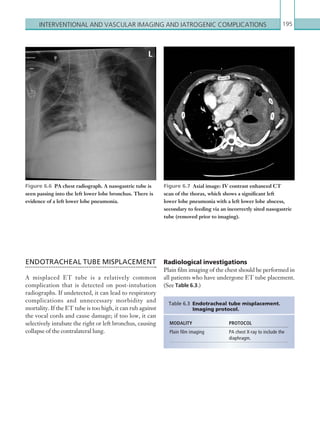 Interventional and ­vascular imaging and iatrogenic ­complications 195
Figure 6.6  PA chest radiograph. A nasogastric tube is
seen passing into the left lower lobe bronchus. There is
evidence of a left lower lobe pneumonia.
Figure 6.7  Axial image: IV contrast enhanced CT
scan of the thorax, which shows a significant left
lower lobe pneumonia with a left lower lobe abscess,
­secondary to feeding via an incorrectly sited nasogastric
tube (removed prior to imaging).
ENDOTRACHEAL TUBE MISPLACEMENT
A misplaced ET tube is a relatively common
complication that is detected on post-intubation
radiographs. If undetected, it can lead to respiratory
complications and unnecessary morbidity and
mortality. If the ET tube is too high, it can rub against
the vocal cords and cause damage; if too low, it can
selectively intubate the right or left bronchus, causing
collapse of the contralateral lung.
Table 6.3 Endotracheal tube misplacement.
Imaging protocol.
MODALITY PROTOCOL
Plain film imaging PA chest X-ray to include the
diaphragm.
Radiological investigations
Plain film imaging of the chest should be performed in
all patients who have undergone ET tube placement.
(See Table 6.3.)
K22247_C006.indd 195 16/05/15 3:12 AM
 