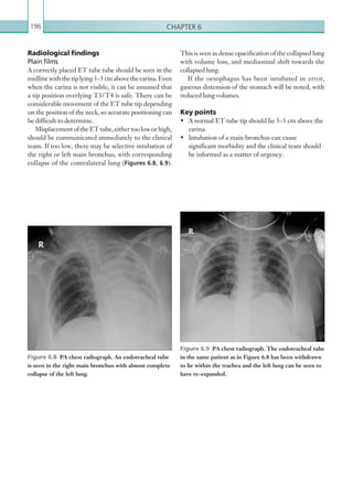 Chapter 6196
This is seen as dense opacification of the collapsed lung
with volume loss, and mediastinal shift towards the
collapsed lung.
If the oesophagus has been intubated in error,
gaseous distension of the stomach will be noted, with
reduced lung volumes.
Key points
•	 A normal ET tube tip should lie 3–5 cm above the
carina.
•	 Intubation of a main bronchus can cause
significant morbidity and the clinical team should
be informed as a matter of urgency.
Radiological findings
Plain films
A correctly placed ET tube tube should be seen in the
midlinewiththetiplying3–5cmabovethecarina.Even
when the carina is not visible, it can be assumed that
a tip position overlying T3/T4 is safe. There can be
considerable movement of the ET tube tip depending
on the position of the neck, so accurate positioning can
be difficult to determine.
MisplacementoftheETtube,eithertooloworhigh,
should be communicated immediately to the clinical
team. If too low, there may be selective intubation of
the right or left main bronchus, with corresponding
collapse of the contralateral lung (Figures 6.8, 6.9).
Figure 6.9  PA chest radiograph. The endotracheal tube
in the same patient as in Figure 6.8 has been ­withdrawn
to lie within the trachea and the left lung can be seen to
have ­re-expanded.
Figure 6.8  PA chest radiograph. An endotracheal tube
is seen in the right main bronchus with almost complete
collapse of the left lung.
K22247_C006.indd 196 16/05/15 3:12 AM
 