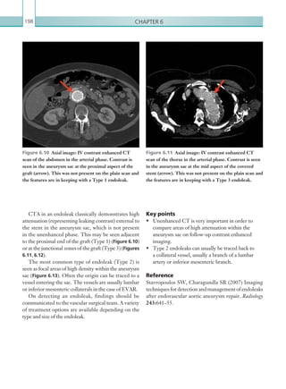 Chapter 6198
Key points
•	 Unenhanced CT is very important in order to
compare areas of high attenuation within the
aneurysm sac on follow-up contrast enhanced
imaging.
•	 Type 2 endoleaks can usually be traced back to
a collateral vessel, usually a branch of a lumbar
artery or inferior mesenteric branch.
Reference
Stavropoulos SW, Charagundla SR (2007) Imaging
techniques for detection and management of endoleaks
after endovascular aortic aneurysm repair. Radiology
243:641–55.
CTA in an endoleak classically demonstrates high
attenuation (representing leaking contrast) external to
the stent in the aneurysm sac, which is not present
in the unenhanced phase. This may be seen adjacent
to the proximal end of the graft (Type 1) (Figure 6.10)
or at the junctional zones of the graft (Type 3) (Figures
6.11, 6.12).
The most common type of endoleak (Type 2) is
seen as focal areas of high density within the aneurysm
sac (Figure 6.13). Often the origin can be traced to a
vessel entering the sac. The vessels are usually lumbar
or inferior mesenteric collaterals in the case of EVAR.
On detecting an endoleak, findings should be
communicated to the vascular surgical team. A variety
of treatment options are available depending on the
type and size of the endoleak.
Figure 6.11  Axial image: IV contrast enhanced CT
scan of the thorax in the arterial phase. Contrast is seen
in the aneurysm sac at the mid aspect of the covered
stent (arrow). This was not present on the plain scan and
the features are in keeping with a Type 3 endoleak.
Figure 6.10  Axial image: IV contrast enhanced CT
scan of the abdomen in the arterial phase. Contrast is
seen in the aneurysm sac at the proximal aspect of the
graft (arrow). This was not present on the plain scan and
the features are in keeping with a Type 1 endoleak.
K22247_C006.indd 198 16/05/15 3:12 AM
 