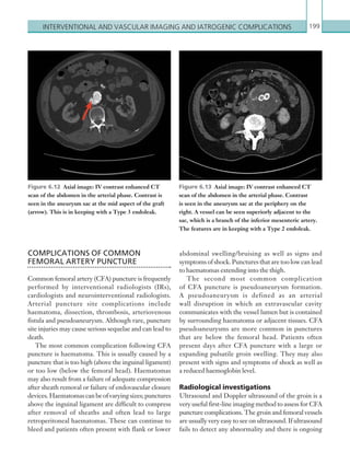 Interventional and ­vascular imaging and iatrogenic ­complications 199
COMPLICATIONS OF COMMON
FEMORAL ARTERY PUNCTURE
Common femoral artery (CFA) puncture is frequently
performed by interventional radiologists (IRs),
cardiologists and neurointerventional radiologists.
Arterial puncture site complications include
haematoma, dissection, thrombosis, arteriovenous
fistula and pseudoaneurysm. Although rare, puncture
site injuries may cause serious sequelae and can lead to
death.
The most common complication following CFA
puncture is haematoma. This is usually caused by a
puncture that is too high (above the inguinal ligament)
or too low (below the femoral head). Haematomas
may also result from a failure of adequate compression
after sheath removal or failure of endovascular closure
devices.Haematomascanbeofvaryingsizes;punctures
above the inguinal ligament are difficult to compress
after removal of sheaths and often lead to large
retroperitoneal haematomas. These can continue to
bleed and patients often present with flank or lower
abdominal swelling/bruising as well as signs and
symptoms of shock. Punctures that are too low can lead
to haematomas extending into the thigh.
The second most common complication
of CFA puncture is pseudoaneurysm formation.
A pseudoaneurysm is defined as an arterial
wall disruption in which an extravascular cavity
communicates with the vessel lumen but is contained
by surrounding haematoma or adjacent tissues. CFA
pseudoaneurysms are more common in punctures
that are below the femoral head. Patients often
present days after CFA puncture with a large or
expanding pulsatile groin swelling. They may also
present with signs and symptoms of shock as well as
a reduced haemoglobin level.
Radiological investigations
Ultrasound and Doppler ultrasound of the groin is a
very useful first-line imaging method to assess for CFA
puncture complications. The groin and femoral vessels
are usually very easy to see on ultrasound. If ultrasound
fails to detect any abnormality and there is ongoing
Figure 6.12  Axial image: IV contrast enhanced CT
scan of the abdomen in the arterial phase. Contrast is
seen in the aneurysm sac at the mid aspect of the graft
(arrow). This is in keeping with a Type 3 endoleak.
Figure 6.13  Axial image: IV contrast enhanced CT
scan of the abdomen in the arterial phase. Contrast
is seen in the aneurysm sac at the periphery on the
right. A vessel can be seen superiorly adjacent to the
sac, which is a branch of the inferior mesenteric artery.
The ­features are in keeping with a Type 2 endoleak.
K22247_C006.indd 199 16/05/15 3:12 AM
 