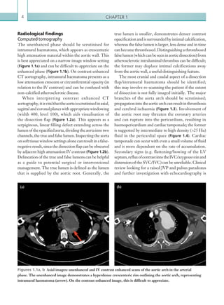 Chapter 14
Radiological findings
Computed tomography
The unenhanced phase should be scrutinised for
intramural haematoma, which appears as crescenteric
high attenuation material within the aortic wall. This
is best appreciated on a narrow image window setting
(Figure 1.1a) and can be difficult to appreciate on the
enhanced phase (Figure 1.1b). On contrast enhanced
CT aortography, intramural haematoma presents as a
low attenuation crescent or circumferential opacity (in
relation to the IV contrast) and can be confused with
non-calcified atherosclerotic disease.
When interpreting contrast enhanced CT
aortography,itisvitalthattheaortaisscrutinisedinaxial,
sagittalandcoronalplaneswithappropriatewindowing
(width 400, level 100), which aids visualisation of
the dissection flap (Figure 1.2a). This appears as a
serpiginous, linear filling defect extending across the
lumenoftheopacifiedaorta,dividingtheaortaintotwo
channels, the true and false lumen. Inspecting the aorta
onsofttissuewindowsettingsalonecanresultinafalse-
negativeresult,sincethedissectionflapcanbeobscured
by adjacent high attenuation IV contrast (Figure 1.2b).
Delineation of the true and false lumens can be helpful
as a guide to potential surgical or interventional
management. The true lumen is defined as the lumen
that is supplied by the aortic root. Generally, the
true lumen is smaller, demonstrates denser contrast
opacificationandissurroundedbyintimalcalcification,
whereas the false lumen is larger, less dense and in time
can become thrombosed. Distinguishing a thrombosed
falselumen(whichcanbeseeninaorticdissection)from
atherosclerotic intraluminal thrombus can be difficult;
the former may displace intimal calcifications away
from the aortic wall, a useful distinguishing feature.
The most cranial and caudal aspect of a dissection
flap/intramural haematoma should be identified;
this may involve re-scanning the patient if the extent
of dissection is not fully imaged initially. The major
branches of the aorta arch should be scrutinised;
propagationintotheaorticarchcanresultinthrombosis
and cerebral ischaemia (Figure 1.3). Involvement of
the aortic root may threaten the coronary arteries
and can rupture into the pericardium, resulting in
haemopericardium and cardiac tamponade; the former
is suggested by intermediate to high density (25 Hu)
fluid in the pericardial space (Figure 1.4). Cardiac
tamponade can occur with even a small volume of fluid
and is more dependent on the rate of accumulation.
Secondary signs (e.g. flattening/bowing of the LV
septum,refluxofcontrastintotheIVC/azygousveinand
distension of the SVC/IVC) can be unreliable. Clinical
review looking for a raised JVP and pulsus paradoxus
and further investigation with echocardiography is
Figures 1.1a, b  Axial images: unenhanced and IV contrast enhanced scans of the aortic arch in the arterial
phase. The unenhanced image demonstrates a hyperdense crescenteric rim outlining the aortic arch, representing
intramural haematoma (arrow). On the contrast enhanced image, this is difficult to appreciate.
(a) (b)
K22247_C001.indd 4 16/05/15 3:06 AM
 