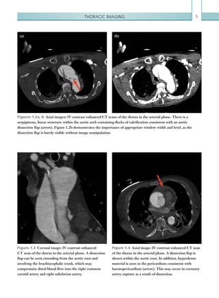 5Thoracic imaging
Figure 1.3  Coronal image: IV contrast enhanced
CT scan of the thorax in the arterial phase. A dissection
flap can be seen extending from the aortic root and
involving the brachiocephalic trunk, which may
compromise distal blood flow into the right common
carotid artery and right subclavian artery.
Figure 1.4  Axial image: IV contrast enhanced CT scan
of the thorax in the arterial phase. A dissection flap is
shown within the aortic root. In addition, hyperdense
material is seen in the pericardium consistent with
haemopericardium (arrow). This may occur in coronary
artery rupture as a result of dissection.
Figures 1.2a, b  Axial images: IV contrast enhanced CT scans of the thorax in the arterial phase. There is a
serpiginous, linear structure within the aortic arch containing flecks of calcification consistent with an aortic
dissection flap (arrow). Figure 1.2b demonstrates the importance of appropriate window width and level, as the
dissection flap is barely visible without image manipulation.
(a) (b)
K22247_C001.indd 5 16/05/15 3:06 AM
 