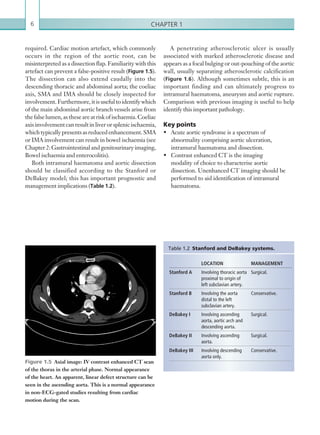 Chapter 16
required. Cardiac motion artefact, which commonly
occurs in the region of the aortic root, can be
misinterpreted as a dissection flap. Familiarity with this
artefact can prevent a false-positive result (Figure 1.5).
The dissection can also extend caudally into the
descending thoracic and abdominal aorta; the coeliac
axis, SMA and IMA should be closely inspected for
involvement. Furthermore, it is useful to identify which
of the main abdominal aortic branch vessels arise from
thefalselumen,astheseareatriskofischaemia.Coeliac
axisinvolvementcanresultin liver or splenic ischaemia,
whichtypicallypresentsasreducedenhancement.SMA
or IMA involvement can result in bowel ischaemia (see
Chapter 2:Gastrointestinalandgenitourinaryimaging,
Bowel ischaemia and enterocolitis).
Both intramural haematoma and aortic dissection
should be classified according to the Stanford or
DeBakey model; this has important prognostic and
management implications (Table 1.2).
LOCATION MANAGEMENT
Stanford A Involving thoracic aorta
proximal to origin of
left subclavian artery.
Surgical.
Stanford B Involving the aorta
distal to the left
subclavian artery.
Conservative.
DeBakey I Involving ascending
aorta, aortic arch and
descending aorta.
Surgical.
DeBakey II Involving ascending
aorta.
Surgical.
DeBakey III Involving descending
aorta only.
Conservative.
Table 1.2  Stanford and DeBakey systems.
Figure 1.5  Axial image: IV contrast enhanced CT scan
of the thorax in the arterial phase. Normal appearance
of the heart. An apparent, linear defect structure can be
seen in the ascending aorta. This is a normal appearance
in non-ECG-gated studies resulting from cardiac
motion during the scan.
A penetrating atherosclerotic ulcer is usually
associated with marked atherosclerotic disease and
appears as a focal bulging or out-pouching of the aortic
wall, usually separating atherosclerotic calcification
(Figure 1.6). Although sometimes subtle, this is an
important finding and can ultimately progress to
intramural haematoma, aneurysm and aortic rupture.
Comparison with previous imaging is useful to help
identify this important pathology.
Key points
•	 Acute aortic syndrome is a spectrum of
abnormality comprising aortic ulceration,
intramural haematoma and dissection.
•	 Contrast enhanced CT is the imaging
modality of choice to characterise aortic
dissection. Unenhanced CT imaging should be
performed to aid identification of intramural
haematoma.
K22247_C001.indd 6 16/05/15 3:06 AM
 
