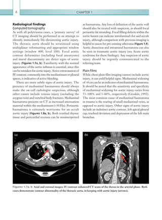 Chapter 18
as haematoma. Any loss of definition of the aortic wall
should also be treated with suspicion, as should focal
periaortic fat stranding. Focal filling defects within the
aortic lumen can indicate intraluminal clot and occult
injury, although comparison with previous imaging is
helpful to assess for pre-existing atheroma (Figure 1.9).
Aortic dissection and intramural haematoma can also
be seen in traumatic aortic injury (see Acute aortic
syndrome for these findings). Any suspicion of aortic
injury should be urgently communicated to the
referring team.
Plain films
While chest plain film imaging cannot exclude aortic
injury, it can yield helpful signs. Mediastinal widening
of 8cm canbeanindicator of mediastinal haematoma.
It should be noted that the sensitivity and specificity
of mediastinal widening for aortic injury varies from
53–100% and 1–60%, respectively (Groskin, 1992).
The most common cause of mediastinal haematoma
in trauma is the tearing of small mediastinal veins, as
opposed to aortic injury. Other signs of aortic injury
include an indistinct aortic contour, left apical pleural
cap, tracheal deviation and depression of the left main
bronchus.
Radiological findings
Computed tomography
As with all polytrauma cases, a ‘primary survey’ of
CT imaging should be performed in an attempt to
identify immediately life-threatening aortic injury.
The thoracic aorta should be scrutinised using
multiplanar reformatting and appropriate window
settings (window 400, level 100). Focal aortic
contour deformities (including focal aneurysms)
and mural discontinuity are direct signs of aortic
injury (Figures 1.7a, b). Familiarity with the normal
appearance of the aortic isthmus is essential, since this
canbemistakenforaorticinjury.Activeextravasationof
IVcontrast,commonlyintothemediastinumorpleural
spaces, is indicative of active bleeding.
There are more subtle signs of aortic injury. The
presence of mediastinal haematoma should always
make the on-call radiologist suspicious, although
other causes include venous injury (including the
azygous vein) and vertebral body fractures. Mediastinal
haematoma presents on CT as increased attenuation
material within the mediastinum (30 Hu). Periaortic
haematoma is extremely worrisome for an occult
aortic injury (Figures 1.8a, b). Both residual thymic
tissue and pericardial recesses can be misinterpreted
Figures 1.7a, b  Axial and coronal images: IV contrast enhanced CT scans of the thorax in the arterial phase. Both
cases demonstrate contour abnormality of the thoracic aorta, in keeping with aortic injury (arrows).
(a) (b)
K22247_C001.indd 8 16/05/15 3:06 AM
 