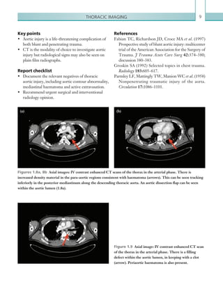 9Thoracic imaging
References
Fabian TC, Richardson JD, Croce MA et al. (1997)
Prospective study of blunt aortic injury: multicenter
trial of the American Association for the Surgery of
Trauma. J Trauma Acute Care Surg 42:374–380;
discussion 380–383.
Groskin SA (1992) Selected topics in chest trauma.
Radiology 183:605–617.
Parmley LF, Mattingly TW, Manion WC et al. (1958)
Nonpenetrating traumatic injury of the aorta.
Circulation 17:1086–1101.
Figure 1.9  Axial image: IV contrast enhanced CT scan
of the thorax in the arterial phase. There is a filling
defect within the aortic lumen, in keeping with a clot
(arrow). Periaortic haematoma is also present.
Figures 1.8a, 8b  Axial images: IV contrast enhanced CT scans of the thorax in the arterial phase. There is
increased density material in the para-aortic regions consistent with haematoma (arrows). This can be seen tracking
inferiorly in the posterior mediastinum along the descending thoracic aorta. An aortic dissection flap can be seen
within the aortic lumen (1.8a).
Key points
•	 Aortic injury is a life-threatening complication of
both blunt and penetrating trauma.
•	 CT is the modality of choice to investigate aortic
injury but radiological signs may also be seen on
plain film radiographs.
Report checklist
•	 Document the relevant negatives of thoracic
aortic injury, including aortic contour abnormality,
mediastinal haematoma and active extravasation.
•	 Recommend urgent surgical and interventional
radiology opinion.
(a) (b)
K22247_C001.indd 9 16/05/15 3:06 AM
 