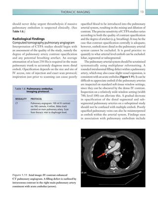 13Thoracic imaging
should never delay urgent thrombolysis if massive
pulmonary embolism is suspected clinically. (See
Table 1.6.)
Radiological findings
Computed tomography pulmonary angiogram
Interpretation of CTPA studies should begin with
an assessment of the quality of the study, namely the
degree of pulmonary artery contrast opacification
and any potential breathing artefact. An average
attenuation of at least 250 Hu is required in the main
pulmonary trunk to accurately diagnose more distal
emboli. Opacification depends on the size and site of
IV access, rate of injection and exact scan protocol;
inspiration just prior to scanning can cause poorly
MODALITY PROTOCOL
CT Pulmonary angiogram: 100 ml IV contrast
via 18G cannula, 4 ml/sec. Bolus track
centred on main pulmonary artery. Scan
from thoracic inlet to diaphragm level.
Table 1.6 Pulmonary embolus.
Imaging protocol.
opacified blood to be introduced into the pulmonary
arterial system, resulting in the mixing and dilution of
contrast. The precise sensitivity of CTPA studies varies
according to both the quality of contrast opacification
and the degree of artefact (e.g. breathing). It may be the
case that contrast opacification centrally is adequate;
however, emboli more distal in the pulmonary arterial
system cannot be excluded. It is good practice to
quantify to what arterial level emboli can be excluded:
lobar, segmental or subsegmental.
Thepulmonaryarterialsystemshouldbescrutinised
systematically using multiplanar reformatting. A
rounded intraluminal filling defect within a pulmonary
artery, which may also cause slight vessel expansion, is
consistentwithanacuteembolus(Figure 1.11).Itcanbe
difficult to appreciate emboli if the pulmonary arteries
are inspected on standard soft tissue window settings,
since they can be obscured by the dense IV contrast.
Inspection on a relatively wide window setting (width
700, level 100) can alleviate this. A gradual decrease
in opacification of the distal segmental and sub-
segmental pulmonary arteries on a suboptimal study
should not be confused with multiple emboli. Poorly
opacified pulmonary veins can also be misinterpreted
as emboli within the arterial system. Findings seen
in association with pulmonary embolism include
Figure 1.11  Axial image: IV contrast enhanced
CT pulmonary angiogram. A filling defect is outlined by
intravenous contrast in the right main pulmonary artery
consistent with acute embolus (arrow).
K22247_C001.indd 13 16/05/15 3:06 AM
 