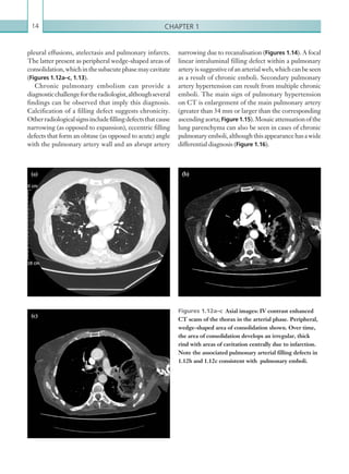 Chapter 114
narrowing due to recanalisation (Figures 1.14). A focal
linear intraluminal filling defect within a pulmonary
artery is suggestive of an arterial web, which can be seen
as a result of chronic emboli. Secondary pulmonary
artery hypertension can result from multiple chronic
emboli. The main sign of pulmonary hypertension
on CT is enlargement of the main pulmonary artery
(greater than 34 mm or larger than the corresponding
ascendingaorta;Figure 1.15).Mosaicattenuationofthe
lung parenchyma can also be seen in cases of chronic
pulmonary emboli, although this appearance has a wide
differential diagnosis (Figure 1.16).
pleural effusions, atelectasis and pulmonary infarcts.
The latter present as peripheral wedge-shaped areas of
consolidation,which inthesubacutephasemaycavitate
(Figures 1.12a–c, 1.13).
Chronic pulmonary embolism can provide a
diagnosticchallengefortheradiologist,althoughseveral
findings can be observed that imply this diagnosis.
Calcification of a filling defect suggests chronicity.
Otherradiologicalsignsincludefillingdefectsthatcause
narrowing (as opposed to expansion), eccentric filling
defects that form an obtuse (as opposed to acute) angle
with the pulmonary artery wall and an abrupt artery
Figures 1.12a–c  Axial images: IV contrast enhanced
CT scans of the thorax in the arterial phase. Peripheral,
wedge-shaped area of consolidation shown. Over time,
the area of consolidation develops an irregular, thick
rind with areas of cavitation centrally due to infarction.
Note the associated pulmonary arterial filling defects in
1.12b and 1.12c consistent with pulmonary emboli.
(a) (b)(b)
(c)
K22247_C001.indd 14 16/05/15 3:06 AM
 