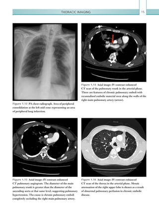 15Thoracic imaging
Figure 1.13  PA chest radiograph. Area of peripheral
consolidation at the left mid zone representing an area
of peripheral lung infarction.
Figure 1.14  Axial image: IV contrast enhanced
CT scan of the pulmonary trunk in the arterial phase.
There are features of chronic pulmonary emboli with
recannalised embolic material seen along the walls of the
right main pulmonary artery (arrow).
Figure 1.15  Axial image: IV contrast enhanced
CT pulmonary angiogram. The diameter of the main
pulmonary trunk is greater than the diameter of the
ascending aorta at that same level, suggesting pulmonary
hypertension. The cause is chronic pulmonary emboli
completely occluding the right main pulmonary artery.
Figure 1.16  Axial image: IV contrast enhanced
CT scan of the thorax in the arterial phase. Mosaic
attenuation of the right upper lobe is shown as a result
of abnormal pulmonary perfusion in chronic embolic
disease.
K22247_C001.indd 15 16/05/15 3:06 AM
 