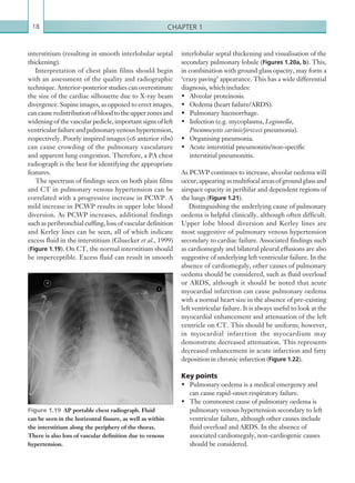 Chapter 118
interlobular septal thickening and visualisation of the
secondary pulmonary lobule (Figures 1.20a, b). This,
in combination with ground glass opacity, may form a
‘crazy paving’ appearance. This has a wide differential
diagnosis, which includes:
•	 Alveolar proteinosis.
•	 Oedema (heart failure/ARDS).
•	 Pulmonary haemorrhage.
•	 Infection (e.g. mycoplasma, Legionella,
Pneumocystis carinii/jiroveci pneumonia).
•	 Organising pneumonia.
•	 Acute interstitial pneumonitis/non-specific
interstitial pneumonitis.
As PCWP continues to increase, alveolar oedema will
occur, appearing as multifocal areas of ground glass and
airspace opacity in perihilar and dependent regions of
the lungs (Figure 1.21).
Distinguishing the underlying cause of pulmonary
oedema is helpful clinically, although often difficult.
Upper lobe blood diversion and Kerley lines are
most suggestive of pulmonary venous hypertension
secondary to cardiac failure. Associated findings such
as cardiomegaly and bilateral pleural effusions are also
suggestive of underlying left ventricular failure. In the
absence of cardiomegaly, other causes of pulmonary
oedema should be considered, such as fluid overload
or ARDS, although it should be noted that acute
myocardial infarction can cause pulmonary oedema
with a normal heart size in the absence of pre-existing
left ventricular failure. It is always useful to look at the
myocardial enhancement and attenuation of the left
ventricle on CT. This should be uniform; however,
in myocardial infarction the myocardium may
demonstrate decreased attenuation. This represents
decreased enhancement in acute infarction and fatty
deposition in chronic infarction (Figure 1.22).
Key points
•	 Pulmonary oedema is a medical emergency and
can cause rapid-onset respiratory failure.
•	 The commonest cause of pulmonary oedema is
pulmonary venous hypertension secondary to left
ventricular failure, although other causes include
fluid overload and ARDS. In the absence of
associated cardiomegaly, non-cardiogenic causes
should be considered.
interstitium (resulting in smooth interlobular septal
thickening).
Interpretation of chest plain films should begin
with an assessment of the quality and radiographic
technique. Anterior-posterior studies can overestimate
the size of the cardiac silhouette due to X-ray beam
divergence. Supine images, as opposed to erect images,
cancauseredistributionofbloodtotheupperzonesand
widening of the vascular pedicle, important signs of left
ventricularfailureandpulmonaryvenoushypertension,
respectively. Poorly inspired images (6 anterior ribs)
can cause crowding of the pulmonary vasculature
and apparent lung congestion. Therefore, a PA chest
radiograph is the best for identifying the appropriate
features.
The spectrum of findings seen on both plain films
and CT in pulmonary venous hypertension can be
correlated with a progressive increase in PCWP. A
mild increase in PCWP results in upper lobe blood
diversion. As PCWP increases, additional findings
such as peribronchial cuffing, loss of vascular definition
and Kerley lines can be seen, all of which indicate
excess fluid in the interstitium (Gluecker et al., 1999)
(Figure 1.19). On CT, the normal interstitium should
be imperceptible. Excess fluid can result in smooth
Figure 1.19  AP portable chest radiograph. Fluid
can be seen in the horizontal fissure, as well as within
the interstitium along the periphery of the thorax.
There is also loss of vascular definition due to venous
hypertension.
K22247_C001.indd 18 16/05/15 3:06 AM
 
