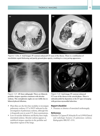 19Thoracic imaging
Report checklist
•	 Presence or absence of associated cardiomegaly.
Reference
GlueckerT,CapassoP,SchnyderPet al.(1999)Clinical
and radiologic features of pulmonary oedema.
Radiographics 19:1507–1531.
•	 Plain films are the first-line modality to investigate
pulmonary oedema. CT is NOT indicated in the
investigation of pulmonary oedema, although this
is frequently seen in acute CT chest examinations.
•	 Loss of vascular definition and Kerley lines imply
interstitial oedema. Alveolar oedema appears as
multifocal airspace opacities in the perihilar and
dependent regions of the lungs.
Figures 1.20a, b  Axial images: IV contrast enhanced CT scans of the thorax. There is a combination of
interlobular septal thickening and patchy ground glass opacity, resulting in a crazy paving appearance.
Figure 1.21  AP chest radiograph. There are bilateral,
perihilar airspace opacities consistent with alveolar
oedema. The costophrenic angles are not visible due to
bilateral pleural effusions.
Figure 1.22  Axial image: IV contrast enhanced
CT scan of the thorax in the arterial phase. There is
subendocardial fat deposition at the LV apex in keeping
with previous myocardial infarction.
(a) (b)
K22247_C001.indd 19 16/05/15 3:06 AM
 