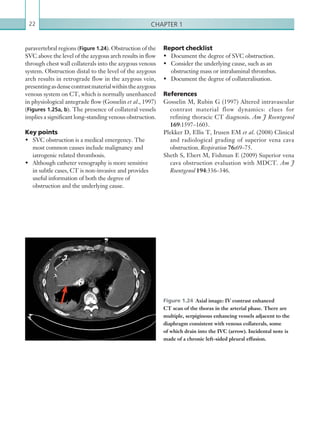 Chapter 122
Report checklist
•	 Document the degree of SVC obstruction.
•	 Consider the underlying cause, such as an
obstructing mass or intraluminal thrombus.
•	 Document the degree of collateralisation.
References
Gosselin M, Rubin G (1997) Altered intravascular
contrast material flow dynamics: clues for
refining thoracic CT diagnosis. Am J Roentgenol
169:1597–1603.
Plekker D, Ellis T, Irusen EM et al. (2008) Clinical
and radiological grading of superior vena cava
obstruction. Respiration 76:69–75.
Sheth S, Ebert M, Fishman E (2009) Superior vena
cava obstruction evaluation with MDCT. Am J
Roentgenol 194:336–346.
paravertebral regions (Figure 1.24). Obstruction of the
SVC above the level of the azygous arch results in flow
through chest wall collaterals into the azygous venous
system. Obstruction distal to the level of the azygous
arch results in retrograde flow in the azygous vein,
presentingasdensecontrastmaterialwithintheazygous
venous system on CT, which is normally unenhanced
in physiological antegrade flow (Gosselin et al., 1997)
(Figures 1.25a, b). The presence of collateral vessels
implies a significant long-standing venous obstruction.
Key points
•	 SVC obstruction is a medical emergency. The
most common causes include malignancy and
iatrogenic related thrombosis.
•	 Although catheter venography is more sensitive
in subtle cases, CT is non-invasive and provides
useful information of both the degree of
obstruction and the underlying cause.
Figure 1.24  Axial image: IV contrast enhanced
CT scan of the thorax in the arterial phase. There are
multiple, serpiginous enhancing vessels adjacent to the
diaphragm consistent with venous collaterals, some
of which drain into the IVC (arrow). Incidental note is
made of a chronic left-sided pleural effusion.
K22247_C001.indd 22 16/05/15 3:06 AM
 