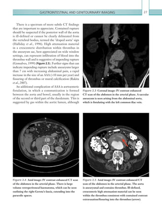 Gastrointestinal and genitourinary imaging 27
Figure 2.3  Coronal image: IV contrast enhanced
CT scan of the abdomen in the arterial phase. A saccular
aneurysm is seen arising from the abdominal aorta,
which is fistulating with the left common iliac vein.
Figure 2.4  Axial image: IV contrast enhanced CT scan
of the abdomen in the arterial phase. There is large
volume retroperitoneal haematoma, which can be seen
outlining the right Gerota’s fascia, extending into the
paracolic spaces.
Figure 2.5  Axial image: IV contrast enhanced CT
scan of the abdomen in the arterial phase. The aorta
is aneurysmal and contains thrombus. Ill-defined,
­­crescenteric high attenuation material can be seen
within the ­thrombus consistent with contained contrast
extravasation/­fissuring into the thrombus (arrow).
There is a spectrum of more subtle CT findings
that are important to appreciate. Contained rupture
should be suspected if the posterior wall of the aorta
is ill-defined or cannot be clearly delineated from
the vertebral bodies, termed the ‘draped aorta’ sign
(Halliday et al., 1996). High attenuation material
in a crescenteric distribution within thrombus in
the aneurysm sac, best appreciated on wide window
settings, can represent infiltration of blood into the
thrombus wall and is suggestive of impending rupture
(Gonsalves, 1999) (Figure 2.5). Further signs that can
indicate impending rupture include aneurysms larger
than 7 cm with increasing abdominal pain, a rapid
increase in the size of an AAA (10 mm per year) and
fissuring of thrombus or mural calcification (Rakita
et al., 2007).
An additional complication of AAA is aortoenteric
fistulation, in which a communication is formed
between the aorta and bowel, usually in the region
of the second or third part of the duodenum. This is
suggested by gas within the aortic lumen, although
K22247_C002.indd 27 16/05/15 3:07 AM
 