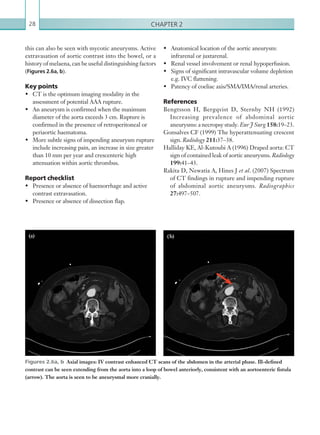 Chapter 228
this can also be seen with mycotic aneurysms. Active
extravasation of aortic contrast into the bowel, or a
history of melaena, can be useful distinguishing factors
(Figures 2.6a, b).
Key points
•	 CT is the optimum imaging modality in the
assessment of potential AAA rupture.
•	 An aneurysm is confirmed when the maximum
diameter of the aorta exceeds 3 cm. Rupture is
confirmed in the presence of retroperitoneal or
periaortic haematoma.
•	 More subtle signs of impending aneurysm rupture
include increasing pain, an increase in size greater
than 10 mm per year and crescenteric high
attenuation within aortic thrombus.
Report checklist
•	 Presence or absence of haemorrhage and active
contrast extravasation.
•	 Presence or absence of dissection flap.
Figures 2.6a, b  Axial images: IV contrast enhanced CT scans of the abdomen in the arterial phase. Ill-defined
contrast can be seen extending from the aorta into a loop of bowel anteriorly, consistent with an aortoenteric fistula
(arrow). The aorta is seen to be aneurysmal more cranially.
(a) ( b)
•	 Anatomical location of the aortic aneurysm:
infrarenal or juxtarenal.
•	 Renal vessel involvement or renal hypoperfusion.
•	 Signs of significant intravascular volume depletion
e.g. IVC flattening.
•	 Patency of coeliac axis/SMA/IMA/renal arteries.
References
Bengtsson H, Bergqvist D, Sternby NH (1992)
Increasing prevalence of abdominal aortic
aneurysms: a necropsy study. Eur J Surg 158:19–23.
Gonsalves CF (1999) The hyperattenuating crescent
sign. Radiology 211:37–38.
Halliday KE, Al-Kutoubi A (1996) Draped aorta: CT
sign of contained leak of aortic aneurysms. Radiology
199:41–43.
Rakita D, Newatia A, Hines J et al. (2007) Spectrum
of CT findings in rupture and impending rupture
of abdominal aortic aneurysms. Radiographics
27:497–507.
K22247_C002.indd 28 16/05/15 3:07 AM
 