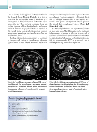 Chapter 230
This is usually more apparent and accumulates on
the delayed phase (Figures 2.7, 2.8). It is vital to
scrutinise the unenhanced phase to assess for pre-
existing foci of high attenuation within the bowel
lumen that may lead to false positives; these can
include ingested tablets, foreign bodies and suture
material. Previous imaging should also be reviewed in
this regard. Cone beam artefact is another common
false positive, occurring at interfaces between fluid and
air within the bowel.
Bleeding in the distal oesophagus may be secondary
to oesophageal varices, a complication of portal
hypertension. These may be visualised as dilated,
•	 Splenomegaly.
•	 Ascites.
•	 Varices: splenic/oesophageal.
•	 Underlying cause (i.e. liver cirrhosis with atrophy and
nodular/irregular contour).
•	 Contrast enhancement of para-umbilical vein.
Table 2.4 Computed tomographic signs of
portal hypertension.
Figure 2.7  Axial image: contrast enhanced CT scan of
the abdomen in the arterial phase. Hyperdense material
can be seen in a dependent position within the lumen of
the ascending colon (arrow), consistent with an acute,
arterial haemorrhage.
Figure 2.8  Axial image: contrast enhanced CT scan of
the abdomen in the delayed phase. On delayed imaging,
further contrast has accumulated within the lumen
of the ascending colon as a result of continued, active
haemorrhage at this site.
serpiginous enhancing vessels in the region of the distal
oesophagus. Findings suggestive of liver cirrhosis
and portal hypertension, such as an irregular liver
outline and splenic enlargement, should prompt
the search for oesophageal varices (Table 2.4;
Figures 2.9, 2.10).
IfGIbleedingisidentified,itisimportantto consider
anunderlyingcause.Muralthickeningcanbemalignant,
inflammatory, ischaemic or infective in nature, all of
whichcanbecomplicatedbybleeding.Itisalsoimportant
to appreciate that GI bleeding is often intermittent and
it is not uncommon for CTA to be normal, even in
haemodynamically compromised patients.
K22247_C002.indd 30 16/05/15 3:07 AM
 