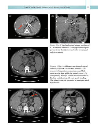 Gastrointestinal and genitourinary imaging 31
Figure 2.9a, b  Axial and coronal images: unenhanced
CT scans of the abdomen. A transjugular intrahepatic
portosystemic shunt (arrow) and coiled oesophageal
varices are shown.
Figures 2.10a–c  Axial images: unenhanced, ­arterial
and delayed phase CT scans of the abdomen. This
sequence of images demonstrates a contrast blush
on the arterial phase within the stomach (arrow). No
­corresponding density is seen on the unenhanced scan.
Findings are in keeping with acute gastric bleeding.
The spleen is enlarged, ­suggestive of underlying portal
hypertension.
(a)
( b)
(c)
( b)(a)
K22247_C002.indd 31 16/05/15 3:07 AM
 
