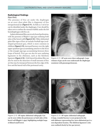 Gastrointestinal and genitourinary imaging 33
Radiological findings
Plain films
The presence of free air under the diaphragm
on an erect chest plain film is diagnostic of free
intraperitoneal air (Figure 2.11). As little as 1 ml of air
can be identified under the diaphragm. Care should be
taken not to confuse the stomach bubble under the left
hemidiaphragm with free air.
Aplainabdominalfilmcanrevealabowelperforation,
with the presence of Rigler’s sign (gas outlining both
sides of the bowel wall) (Figure 2.12). Other abdominal
plain film signs of free air include football sign (oval-
shaped peritoneal gas), which is more common in
children (Figure 2.13), increased lucency over the right
upper quadrant (gas accumulating anterior to the liver)
or the triangle sign (gas accumulating between three
loops of bowel). Free gas can also be seen outlining
ligaments in the abdomen, such as the falciform
ligament (Figure 2.14). A left lateral decubitus film can
also be used in the detection of small amounts of free
air that may be interposed between the free edge of the
liver and the lateral wall of the peritoneal cavity.
Figure 2.11  AP semi-erect chest radiograph. Large
volumes of gas can be seen underneath the diaphragm
consistent with pneumoperitoneum.
Figure 2.13  AP supine abdominal radiograph.
A large, rounded lucency is seen projected in the
­mid-­abdomen representing free intra-abdominal gas in a
­non-dependent location. The falciform ligament is also
seen outlined clearly by free gas (arrow).
Figure 2.12  AP supine abdominal radiograph. Gas
can be seen within the peritoneum on both sides of the
bowel wall (Riggler’s sign), highlighting multiple loops
of dilated small bowel.
K22247_C002.indd 33 16/05/15 3:07 AM
 