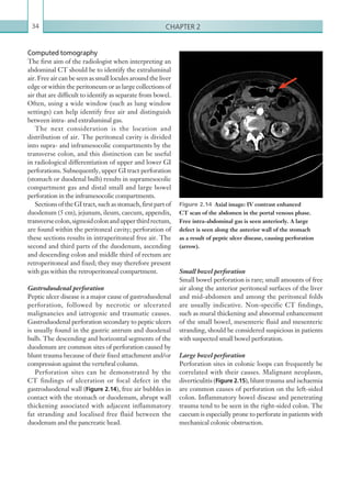 Chapter 234
Computed tomography
The first aim of the radiologist when interpreting an
abdominal CT should be to identify the extraluminal
air. Free air can be seen as small locules around the liver
edge or within the peritoneum or as large collections of
air that are difficult to identify as separate from bowel.
Often, using a wide window (such as lung window
settings) can help identify free air and distinguish
between intra- and extraluminal gas.
The next consideration is the location and
distribution of air. The peritoneal cavity is divided
into supra- and inframesocolic compartments by the
transverse colon, and this distinction can be useful
in radiological differentiation of upper and lower GI
perforations. Subsequently, upper GI tract perforation
(stomach or duodenal bulb) results in supramesocolic
compartment gas and distal small and large bowel
perforation in the inframesocolic compartments.
Sections of the GI tract, such as stomach, first part of
duodenum (5 cm), jejunum, ileum, caecum, appendix,
transversecolon,sigmoidcolonandupperthirdrectum,
are found within the peritoneal cavity; perforation of
these sections results in intraperitoneal free air. The
second and third parts of the duodenum, ascending
and descending colon and middle third of rectum are
retroperitoneal and fixed; they may therefore present
with gas within the retroperitoneal compartment.
Gastroduodenal perforation
Peptic ulcer disease is a major cause of gastroduodenal
perforation, followed by necrotic or ulcerated
malignancies and iatrogenic and traumatic causes.
Gastroduodenal perforation secondary to peptic ulcers
is usually found in the gastric antrum and duodenal
bulb. The descending and horizontal segments of the
duodenum are common sites of perforation caused by
blunt trauma because of their fixed attachment and/or
compression against the vertebral column.
Perforation sites can be demonstrated by the
CT findings of ulceration or focal defect in the
gastroduodenal wall (Figure 2.14), free air bubbles in
contact with the stomach or duodenum, abrupt wall
thickening associated with adjacent inflammatory
fat stranding and localised free fluid between the
duodenum and the pancreatic head.
Figure 2.14  Axial image: IV contrast enhanced
CT scan of the abdomen in the portal venous phase.
Free intra-abdominal gas is seen anteriorly. A large
defect is seen along the anterior wall of the stomach
as a result of peptic ulcer disease, causing perforation
(arrow).
Small bowel perforation
Small bowel perforation is rare; small amounts of free
air along the anterior peritoneal surfaces of the liver
and mid-abdomen and among the peritoneal folds
are usually indicative. Non-specific CT findings,
such as mural thickening and abnormal enhancement
of the small bowel, mesenteric fluid and mesenteric
stranding, should be considered suspicious in patients
with suspected small bowel perforation.
Large bowel perforation
Perforation sites in colonic loops can frequently be
correlated with their causes. Malignant neoplasm,
diverticulitis (Figure 2.15), blunt trauma and ischaemia
are common causes of perforation on the left-sided
colon. Inflammatory bowel disease and penetrating
trauma tend to be seen in the right-sided colon. The
caecum is especially prone to perforate in patients with
mechanical colonic obstruction.
K22247_C002.indd 34 16/05/15 3:07 AM
 